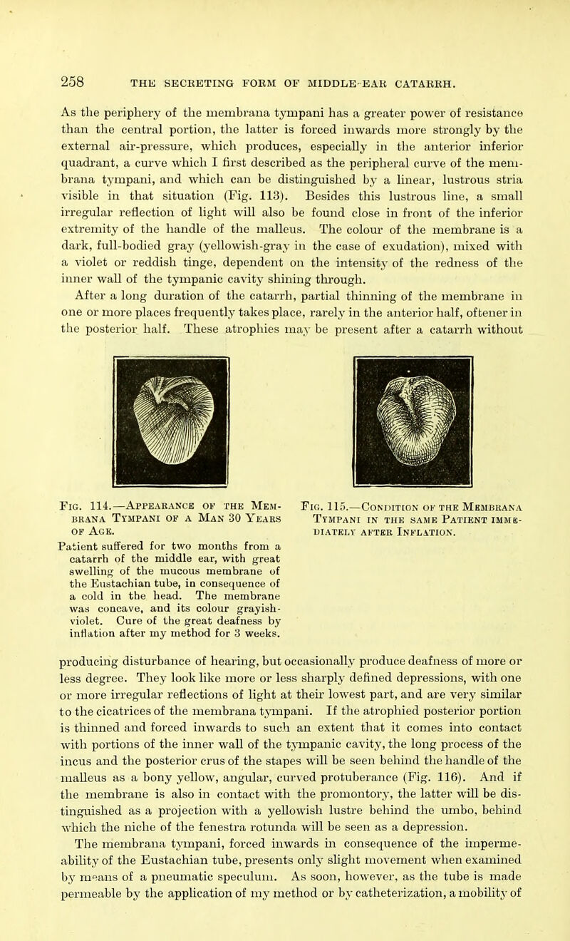 As the periphery of the membrana tympani has a greater power of resistance than the central portion, the latter is forced inwards more strongly by the external air-pressure, which produces, especially in the anterior inferior quadrant, a curve which I first described as the peripheral curve of the mem- brana tympani, and which can be distinguished by a linear, lustrous stria visible in that situation (Fig. 113). Besides this lustrous line, a small irregular reflection of light will also be found close in front of the inferior extremity of the handle of the malleus. The colour of tlie membrane is a dark, full-bodied gray (yellowish-gray in the case of exudation), mixed with a violet or reddish tinge, dependent on the intensity of the redness of the inner waU of the tympanic cavity shining through. After a long dmration of the catarrh, partial thinning of the membrane in one or more places frequently takes place, rarely in the anterior half, of tener in the posterior half. These atrophies may be present after a catarrh without Fig. 114.—Appeakanck ov the Mem- brana Tympani of a Man 30 Years OF Age. Patient suffered for two months from a catarrh of the middle ear, with great swelling of the mucous membrane of the Eustachian tube, in consequence of a cold in the head. The membrane was concave, and its colour grayish- violet. Cure of the great deafness by inflation after my method for 3 weeks. Fig. 115.—Conditcon of the Membrana Tympani in the same Patient imme- UIATBLY after INFLATION. producing disturbance of hearing, but occasionally produce deafness of more or less degree. They look like more or less sharply defined depressions, with one or more irregular reflections of light at their lowest part, and are very similar to the cicatrices of the membrana tympani. If the atrophied posterior portion is thinned and forced inwards to such an extent that it comes into contact with portions of the inner wall of the tjonpanic cavity, the long process of the incus and the posterior crus of the stapes wiU be seen behind the handle of the maUeus as a bony yellow, angular, curved protuberance (Fig. 116). And if the membrane is also in contact with the promontory, the latter will be dis- tinguished as a projection with a yellowish lustre behind the umbo, behind which the niche of the fenestra rotunda will be seen as a depression. The membrana tympani, forced inwards in consequence of the imperme- ability of the Eustachian tube, presents only slight movement when examined by mfians of a pneumatic speculum. As soon, however, as the tube is made permeable by the application of my method or by catheterization, a mobility of