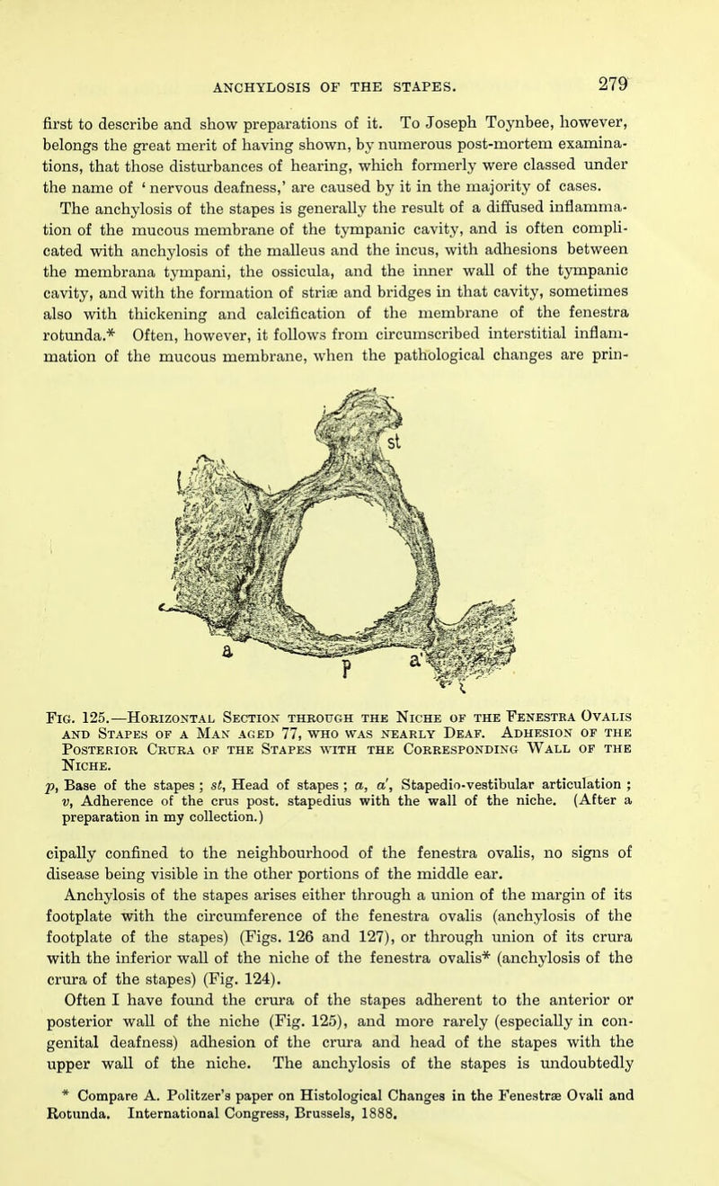 first to describe and show preparations of it. To Joseph Toynbee, however, belongs the great merit of having shown, by numerous post-mortem examina- tions, that those disturbances of hearing, which formerly were classed under the name of ' nervous deafness,' are caused by it in the majority of cases. The anchylosis of the stapes is generally the result of a diffused inflamma- tion of the mucous membrane of the tympanic cavity, and is often compli- cated with anchylosis of the malleus and the incus, with adhesions between the membrana tympani, the ossicula, and the inner wall of the tympanic cavity, and with the formation of striae and bridges in that cavity, sometimes also with thickening and calcification of the membrane of the fenestra rotunda.* Often, however, it follows from circumscribed interstitial inflam- mation of the mucous membrane, when the pathological changes are prin- FiG. 125.—Horizontal Section through the Niche of the Fenestra Ovalis AND Stapes of a Man aged 77, who was nearly Deaf. Adhesion of the Posterior Crura of the Stapes with the Corresponding Wall of the Niche. p, Base of the stapes ; st, Head of stapes ; a, a', Stapedio-vestibular articulation ; V, Adherence of the crus post, stapedius with the wall of the niche. (After a preparation in my collection.) cipally confined to the neighbourhood of the fenestra ovalis, no signs of disease being visible in the other portions of the middle ear. Anchylosis of the stapes arises either through a union of the margin of its footplate with the circumference of the fenestra ovalis (anchylosis of the footplate of the stapes) (Figs. 126 and 127), or through union of its crura with the inferior wall of the niche of the fenestra ovalis* (anchylosis of the crura of the stapes) (Fig. 124). Often I have found the crura of the stapes adherent to the anterior or posterior wall of the niche (Fig. 125), and more rarely (especially in con- genital deafness) adhesion of the crura and head of the stapes with the upper wall of the niche. The anchylosis of the stapes is imdoubtedly * Compare A. Politzer's paper on Histological Changes in the Fenestrse Ovali and Rotunda. International Congress, Brussels, 1888.