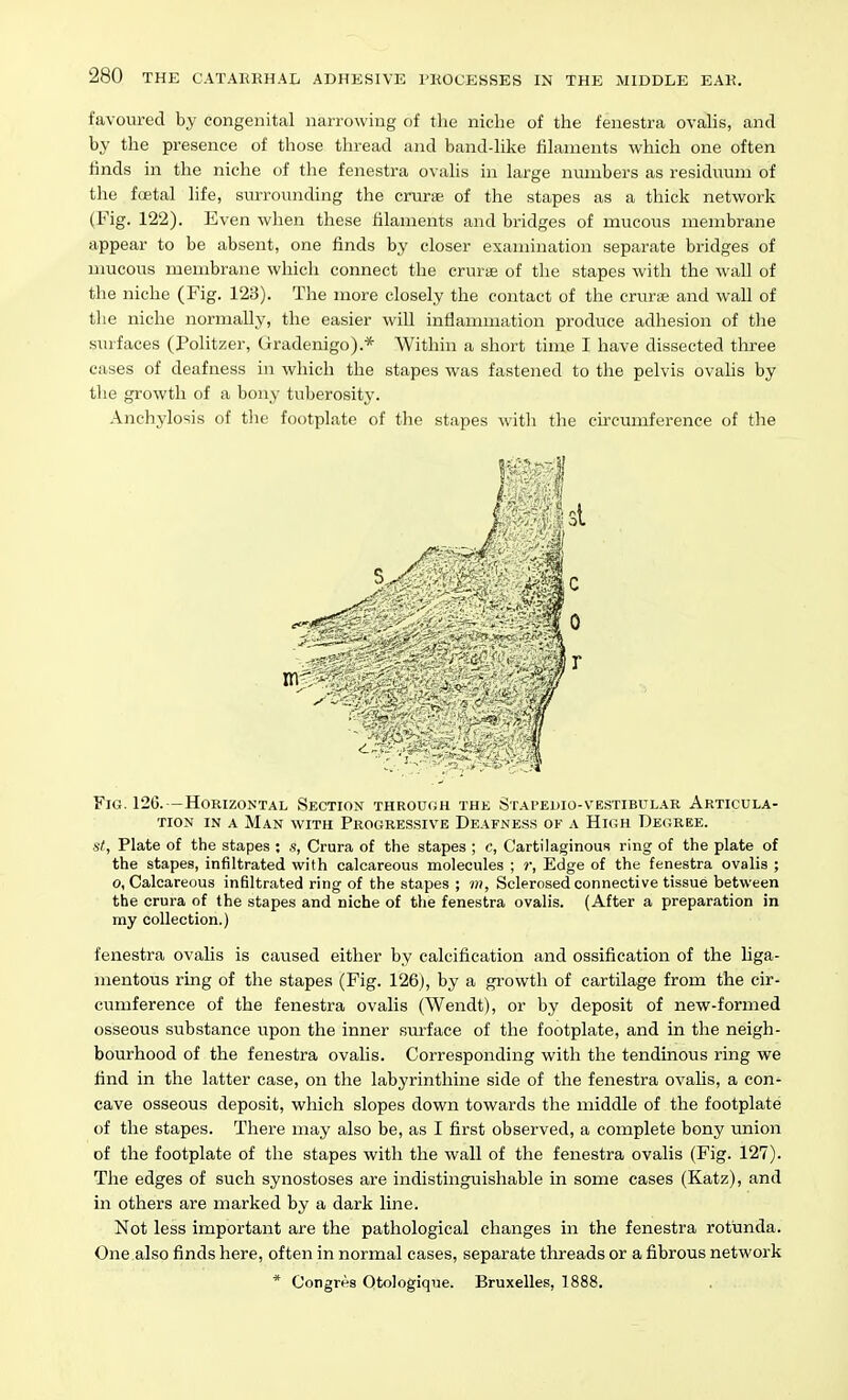 favoured by congenital narrowing of tlie niche of the fenestra ovalis, and by the presence of those thread and band-like filaments which one often finds in the niche of the fenestra ovalis in large numbers as residiium of the foetal life, surrounding the criu-aB of the stapes as a thick network (Fig. 122). Even when these filaments and bridges of mucous membrane appear to be absent, one finds by closer examination separate bridges of mucous membrane which connect the cruras of the stapes with the wall of the niche (Fig. 123). The more closely the contact of the crurse and wall of the niche normally, the easier will inflammation produce adhesion of the surfaces (Politzer, Gradenigo).* Within a short time I have dissected three cases of deafness in which the stapes was fastened to the pelvis ovalis by the growth of a bony tuberosity. Anchylosis of the footplate of the stapes with the circumference of the Fig. 126. —Horizontal Section through the Stapeuio-vestibular Articula- tion IN A Man with Progressive Deafness ok a Hum Degree. s/, Plate of the stapes : ,s, Crura of the stapes ; c, Cartilaginous ring of the plate of the stapes, infiltrated with calcareous molecules ; r, Edge of the fenestra ovalis ; o, Calcareous infiltrated ring of the stapes ; Sclerosed connective tissue between the crura of the stapes and niche of the fenestra ovalis. (After a preparation in my collection.) fenestra ovalis is caused either by calcification and ossification of the liga- mentous ring of the stapes (Fig. 126), by a gi-owth of cartilage from the cir- cumference of the fenestra ovalis (Wendt), or by deposit of new-formed osseous substance upon the inner surface of the footplate, and in the neigh- bourhood of the fenestra ovalis. Corresponding with the tendinous ring we find in the latter case, on the labyrinthine side of the fenestra ovalis, a con- cave osseous deposit, which slopes down towards the middle of the footplate of the stapes. There may also be, as I first observed, a complete bony union of the footplate of the stapes with the wall of the fenestra ovalis (Fig. 127). The edges of such synostoses are indistinguishable in some cases (Katz), and in others are marked by a dark line. Not less important are the pathological changes in the fenestra rotunda. One.also finds here, often in normal cases, separate threads or a fibrous network * Congres Otologiqiie. Bruxelles, 1888.