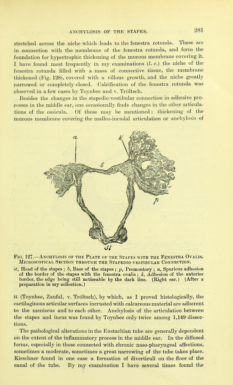 stretched across the niche which leads to the fenestra rotunda. These are in connection with the membrane of the fenestra rotunda, and form the foundation for hypertrophic thickening of the mucous membrane covering it. I have found most frequently in my examinations {I. c.) the niche of the fenestra rotunda fiUed with a mass of connective tissue, the membrane thickened (Fig. 128), covered with a villous growth, and the niche greatly narrowed or completely closed. Calcification of the fenestra rotunda was observed in a few cases by Toynbee and v. Troltsch. Besides the changes in the stapedio-vestibular connection in adhesive pro- cesses in the middle ear, one occasionally finds changes in the other articula- tions of the ossicula. Of these may be mentioned: thickening of the mucous membrane covering the malleo-incudal articulation or anchylosis of Fic. 127.—Anchylosis of the Plate of the Stapes with the Fenestra Ovalis. Microscopical Section through the Stapedio-vestibular Connection. St, Head of the stapes ; b, Base of the stapes ; p, Promontory ; a. Spurious adhesion of the border of the stapes with the fenestra ovalis ; k. Adhesion of the anterior border, the edge being still noticeable by the dark line. (Right ear.) (After a preparation in my collection.) it (Toynbee, Zaufal, v. Troltsch), by which, as I proved histologically, the cartilaginous articular surfaces incrusted with calcareous material are adherent to the meniscus and to each other. Anchylosis of the articulation between the stapes and incus was found by Toynbee only twice among 1,149 dissec- tions. The pathological alterations in the Eustachian tube are generally dependent on the extent of the inflammatory process in the middle ear. In the diffused forms, especially in those connected with chronic naso-pharyngeal affections, sometimes a moderate, sometimes a great narrowing of the tube takes place. Kirschner found in one case a formation of diverticuli on the floor of the canal of the tube. By my examination I have several times found the