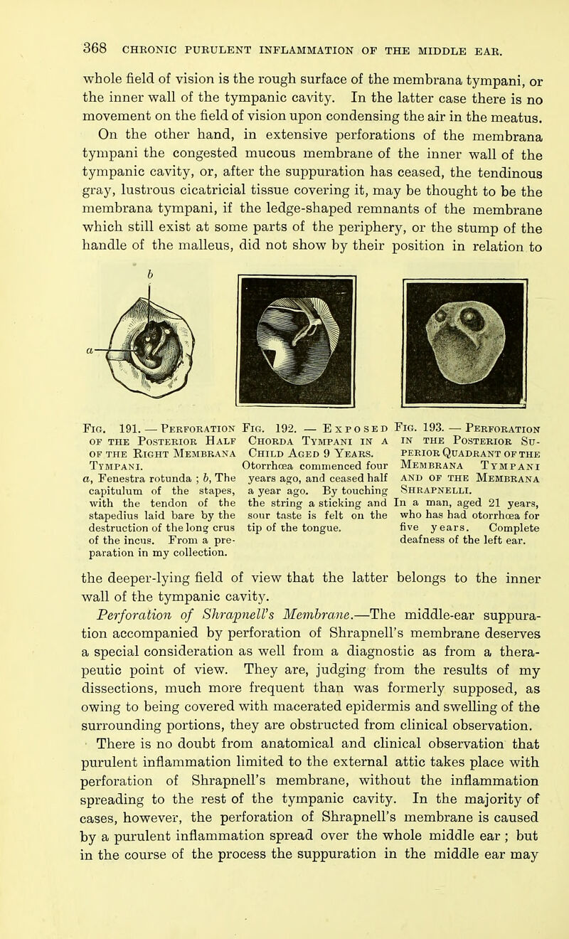 whole field of vision is the rough surface of the membrana tympani, or the inner wall of the tympanic cavity. In the latter case there is no movement on the field of vision upon condensing the air in the meatus. On the other hand, in extensive perforations of the membrana tympani the congested mucous membrane of the inner wall of the tympanic cavity, or, after the suppuration has ceased, the tendinous gray, lustrous cicatricial tissue covering it, may be thought to be the membrana tympani, if the ledge-shaped remnants of the membrane which still exist at some parts of the periphery, or the stump of the handle of the malleus, did not show by their position in relation to Fig. 191. — Perforation Fig. 192. — Exposed Fig. 193.—Perforation OF THE Posterior Half Chorda Tympani in a in the Posterior Su- OF THE Right Membrana Child Aged 9 Years. perior Quadrant of the Ttmpani. Otorrhcea commenced four Membrana Tympani a, Fenestra rotunda ; b, The years ago, and ceased half and of the Membrana capitulum of the stapes, a year ago. By touching Shrapnelli. with the tendon of the the string a sticking and In a man, aged 21 years, stapedius laid bare by the sour taste is felt on the who has had otorrhcea for destruction of the long crus tip of the tongue. five years. Complete of the incus. From a pre- deafness of the left ear. paration in my collection. the deeper-lying field of view that the latter belongs to the inner wall of the tympanic cavity. Perforation of ShrapneU's Membrane.—The middle-ear suppura- tion accompanied by perforation of ShrapneU's membrane deserves a special consideration as well from a diagnostic as from a thera- peutic point of view. They are, judging from the results of my dissections, much more frequent than was formerly supposed, as owing to being covered with macerated epidermis and swelling of the surrounding portions, they are obstructed from clinical observation. There is no doubt from anatomical and clinical observation that purulent inflammation limited to the external attic takes place with, perforation of ShrapneU's membrane, without the inflammation spreading to the rest of the tympanic cavity. In the majority of cases, however, the perforation of ShrapneU's membrane is caused by a purulent inflammation spread over the whole middle ear ; but in the course of the process the suppuration in the middle ear may