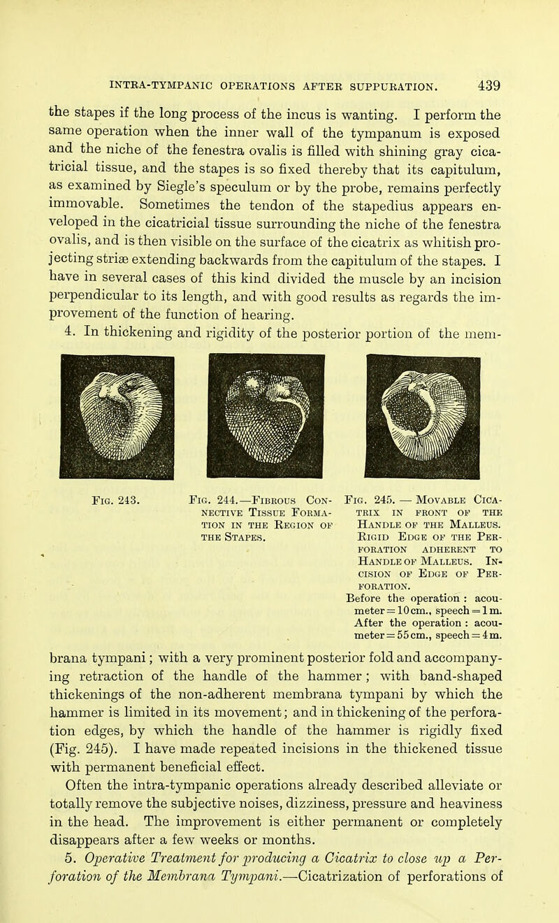 the stapes if the long process of the incus is wanting. I perform the same operation when the inner wall of the tympanum is exposed and the niche of the fenestra ovalis is filled with shining gray cica- tricial tissue, and the stapes is so fixed thereby that its capitulum, as examined by Siegle's speculum or by the probe, remains perfectly immovable. Sometimes the tendon of the stapedius appears en- veloped in the cicatricial tissue surrounding the niche of the fenestra ovalis, and is then visible on the surface of the cicatrix as whitish pro- jecting striae extending backwards from the capitulum of the stapes. I have in several cases of this kind divided the muscle by an incision perpendicular to its length, and with good results as regards the im- provement of the function of hearing. 4. In thickening and rigidity of the posterior portion of the mem- FiG. 24-3. Fig. 244.—Fibrous Con- Fig. 24.'3. — Movable Cica- NECTivE Tissue Forma- trix in front op the TioN IN THE Region of Handle op the Malleus. THE Stapes. Eigid Edge of the Per- foration adherent to Handle of Malleus. In- cision OP Edge of Per- foration. Before the operation : acou- meter= 10cm., speech = liii. After the operation : acou- meter = 55cm., speech = 4m. brana tympani; with a very prominent posterior fold and accompany- ing retraction of the handle of the hammer; with band-shaped thickenings of the non-adherent membrana tympani by which the hammer is limited in its movement; and in thickening of the perfora- tion edges, by which the handle of the hammer is rigidly fixed (Fig. 246). I have made repeated incisions in the thickened tissue with permanent beneficial effect. Often the intra-tympanic operations akeady described alleviate or totally remove the subjective noises, dizziness, pressure and heaviness in the head. The improvement is either permanent or completely disappears after a few weeks or months. 5. Operative Treatment for j^roducing a Cicatrix to close up a Per- foration of the Memhran% Tympani.—-Cicatrization of perforations of