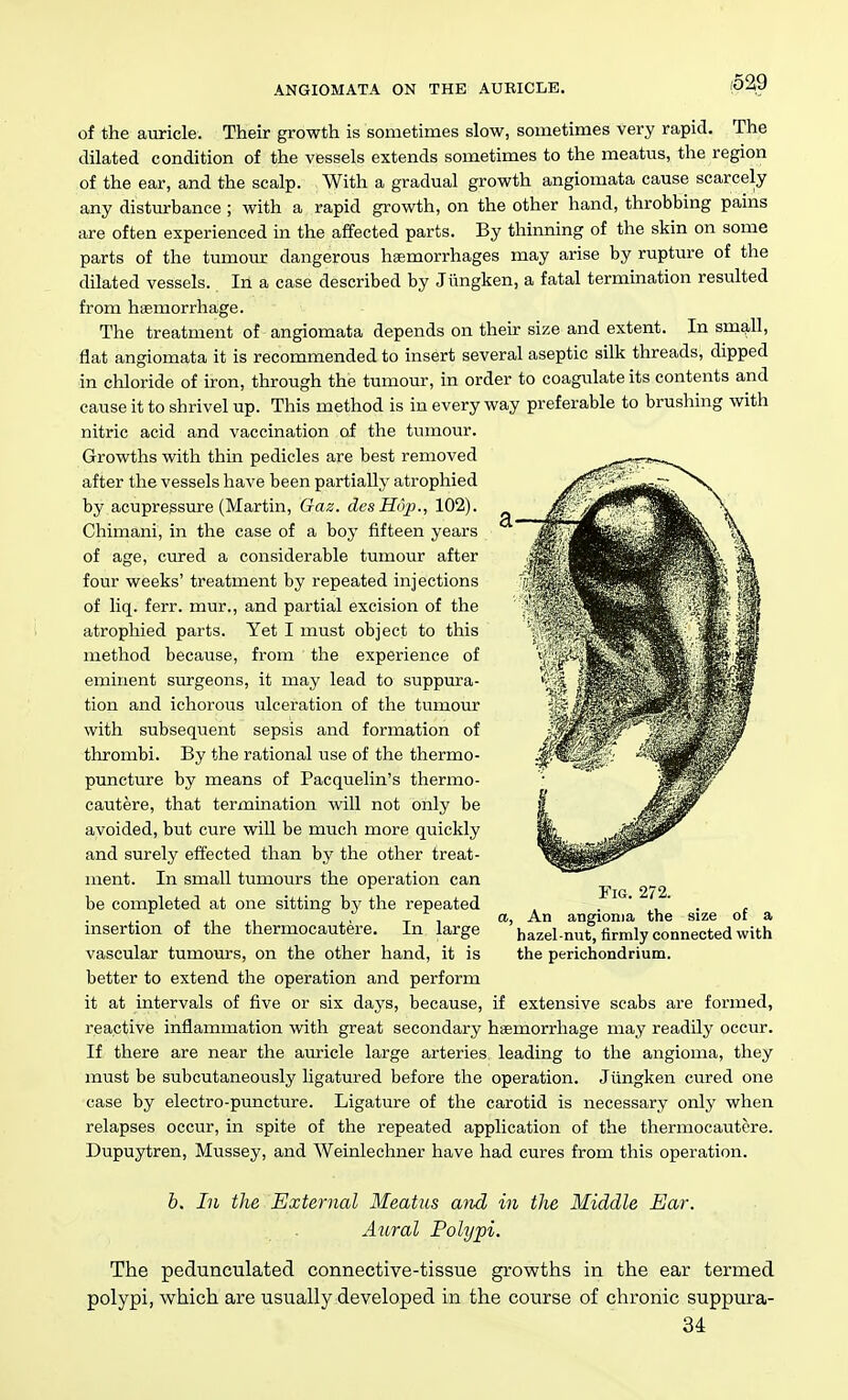 ANGIOMATA ON THE AUEICLE. of the auricle. Their growth is sometimes slow, sometimes very rapid. The dilated condition of the vessels extends sometimes to the meatus, the region of the ear, and the scalp. With a gradual growth angiomata cause scarcely any disturbance ; with a rapid growth, on the other hand, throbbing pains are often experienced in the affected parts. By thinning of the skin on some parts of the tumour dangerous haemorrhages may arise by rupture of the dilated vessels. In a case described by Jiingken, a fatal termination resulted from htemorrhage. The treatment of angiomata depends on their size and extent. In sm9,ll, flat angiomata it is recommended to insert several aseptic silk threads, dipped in chloride of iron, through the tumour, in order to coagulate its contents and cause it to shrivel up. This method is in everyway preferable to brushing with nitric acid and vaccination oi the tumour. Growths with thin pedicles are best removed after the vessels have been partially atrophied by acupressure (Martin, Gaz. dcsHop., 102). Chiniani, in the case of a boy fifteen years of age, cured a considerable tumour after four weeks' treatment by repeated injections of liq. ferr. mur., and partial excision of the atrophied parts. Yet I must object to this method because, from the experience of eminent surgeons, it may lead to suppura- tion and ichorous ulceration of the tumour with subsequent sepsis and formation of thrombi. By the rational use of the thermo- puncture by means of Pacquelin's thermo- cautere, that termination will not only be avoided, but cure will be much more quickly and surely effected than by the other treat- ment. In small tumours the operation can be completed at one sitting by the repeated insertion of the thermocautere. In large vascular tumours, on the other hand, it is better to extend the operation and perform it at intervals of five or six days, because, if extensive scabs are formed, reactive inflammation with great secondary haemorrhage may readily occur. If there are near the auricle large arteries leading to the angioma, they must be subcutaneously ligatured before the operation. Jiingken cured one case by electro-puncture. Ligature of the carotid is necessary only when relapses occur, in spite of the repeated application of the thermocautere. Dupuytren, Mussey, and Weinlechner have had cures from this operation. Fig. 272. a, An angioma the size of a hazel nut, firmly connected with the perichondrium. b. In the External Meatus ajid in the Middle Ear. Aural Polypi. The pedunculated connective-tissue grovyths in the ear termed polypi, which are usually developed in the course of chronic suppura- 34