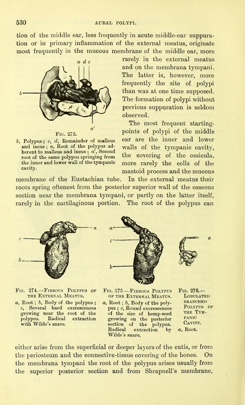 a d c tion of the middle ear, less frequently in acute middle-ear suppura- tion or in primary inflammation of the external meatus, originate most frequently in the mucous membrane of the middle ear, more rarely in the external meatus and on the membrana tympani. The latter is, however, more frequently the site of polypi than was at one time supposed. The formation of polypi without previous suppuration is seldom observed. The most frequent starting- points of polypi of the middle ear are the inner and lower walls of the tympanic cavity, the covering of the ossicula, more rarely the cells of the mastoid process and the mucous In the external meatus their Fig. 2/3. , Polypus; c, eZ, Remainder of malleus and incus ; a, Root of the polypus ad- herent to malleus and incus ; a', Second root of the same polypus springing from the inner and lower wall of the tympanic cavity. membrane of the Eustachian tube roots spring oftenest from the posterior superior wall of the osseous section near the membrana tympani, or partly on the latter itself, rarely in the cartilaginous portion. The root of the polypus can •- ci a Fig. 274.—Fibrous Polypus ob THE External Meatus. o, Root; h. Body of the polypus ; c. Several hard excrescences growing near the root of the polypus. Radical extraction with Wilde's snare. Fig. 275,—Fibrous Polypus Fig. 276.- OF THE External Meatus. a. Root; 6, Body of the poly- pus ; c, Round excrescences of the size of hemp-seed growing on the posterior section of the polypus. Radical extraction by Wilde's snare. Lobulated branched Polypus of the Tym- panic Cavity. a. Root. either arise from the superficial or deeper layers of the cutis, or from the periosteum and the connective-tissue covering of the bones. On the membrana tympani the root of the polypus arises usually from the superior posterior section and from Shrapnell's membrane,