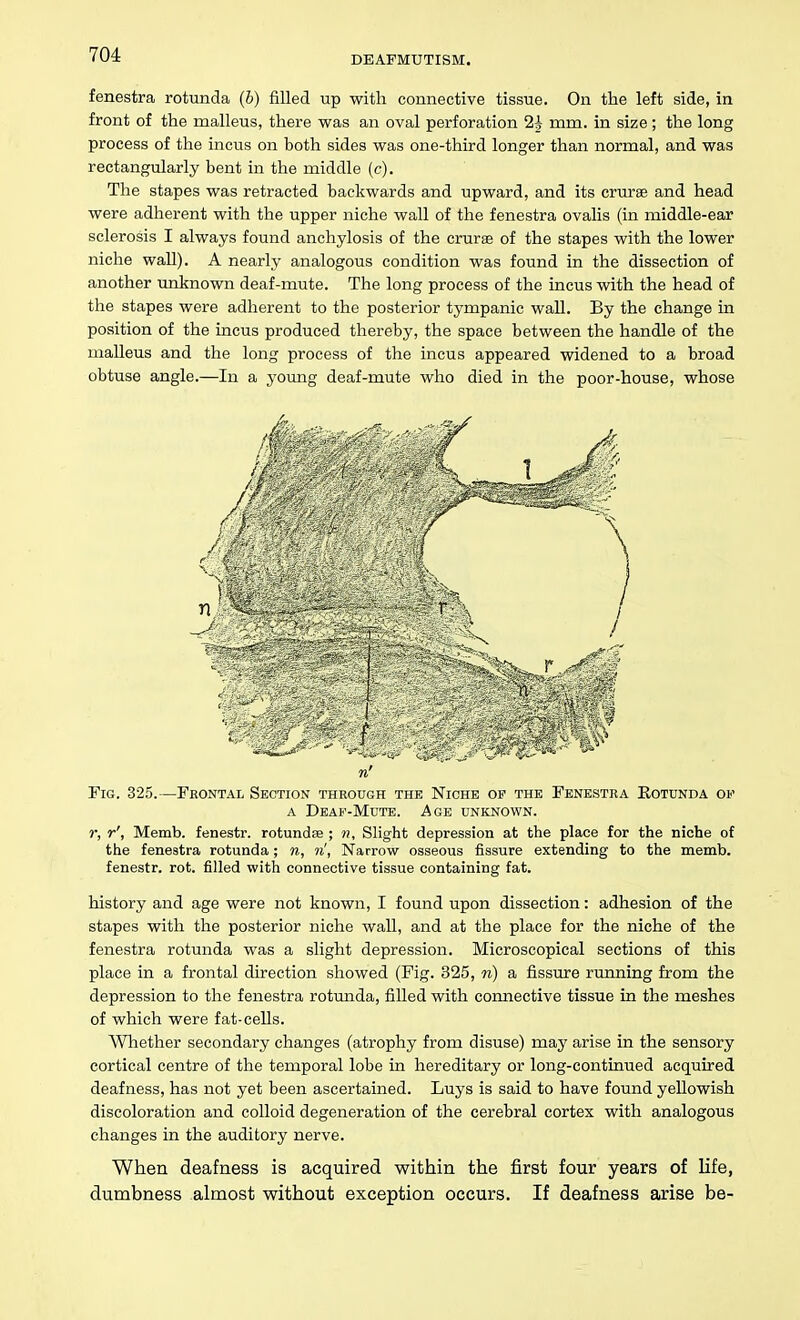 fenestra rotunda (b) filled up with connective tissue. On the left side, in front of the malleus, there was an oval perforation 2J mm. in size; the long process of the incus on both sides was one-third longer than normal, and was rectangularly bent in the middle (c). The stapes was retracted backwards and upward, and its erurae and head were adherent with the upper niche wall of the fenestra ovalis (in middle-ear sclerosis I always found anchylosis of the crurse of the stapes with the lower niche waU). A nearly analogous condition was found in the dissection of another unknown deaf-mute. The long process of the incus with the head of the stapes were adherent to the posterior tympanic wall. By the change in position of the incus produced thereby, the space between the handle of the malleus and the long process of the incus appeared widened to a broad obtuse angle.—In a yomig deaf-mute who died in the poor-house, whose n' Fig. 325.—Frontal Section through the Niche op the Fenestra Eotunda op A Deap-Mute. Age unknown. r, r', Memb. fenestr. rotundfe ; n. Slight depression at the place for the niche of the fenestra rotunda; n, n', Narrow osseous fissure extending to the memb. fenestr. rot. filled with connective tissue containing fat. history and age were not known, I found upon dissection: adhesion of the stapes with the posterior niche wall, and at the place for the niche of the fenestra rotunda was a slight depression. Microscopical sections of this place in a frontal direction showed (Fig. 325, n) a fissure running from the depression to the fenestra rotunda, filled with connective tissue in the meshes of which were fat-cells. Whether secondary changes (atrophy from disuse) may arise in the sensory cortical centre of the temporal lobe in hereditary or long-continued acquired deafness, has not yet been ascertained. Luys is said to have found yellowish discoloration and colloid degeneration of the cerebral cortex with analogous changes in the auditory nerve. When deafness is acquired within the first four years of life, dumbness almost without exception occurs. If deafness arise be-