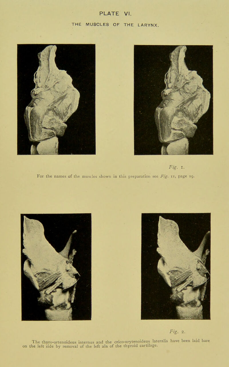 THE MUSCLES OF THE LARYNX. Fig. 2. The thyro-artenoideus internus ami the crico-arytenoideiis lateralis have been laid bar the left side by removal of the left ala of the thyroid cartilage.