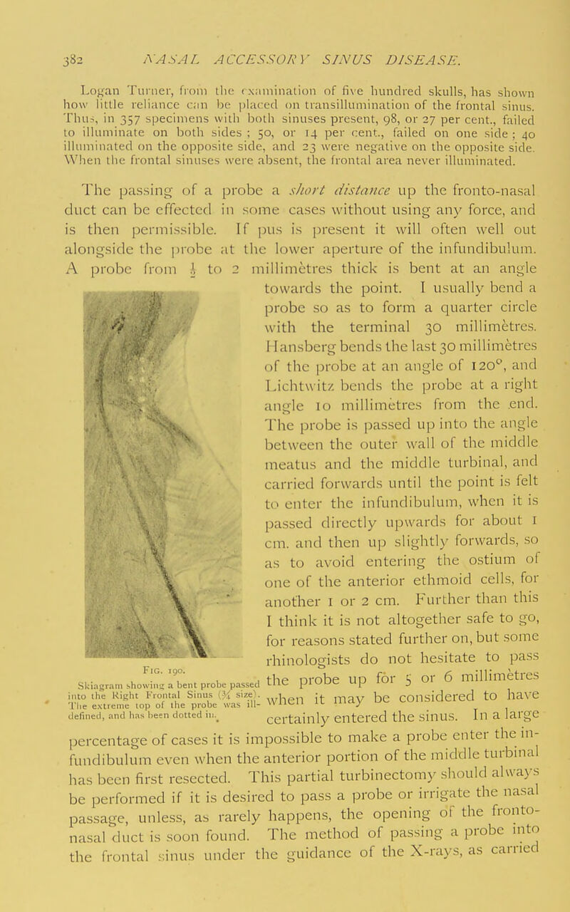 Lo{,'an Tui ner, fiom the (xnminalion of fi\ e luindred skulls, lias shown how little reliance t;;in ho^ jjlacccl on transillumination of the frontal sinus. Thus, in 357 specimens with both sinuses present, 98, or 27 per cent., failed to illuminate on both sides ; 50, or 14 per cent., failed on one side : 40 illimiinated on the opposite side, and 23 were negative on the opposite side. When tiie frontal sinuses were absent, the frontal area never illuminated. The passing of a probe a short distance up the fronto-nasal duct can be effected in some cases without using any force, and is then permissible. If pus is present it will often well out alongside the ])robe at the lower aperture of the infundibulum. A probe from A to 2 millimetres thick is bent at an angle towards the point. I usually bend a probe so as to form a quarter circle with the terminal 30 millimetres. 11 ansberg bends the last 30 millimetres of the probe at an angle of 120'', and Lichtw itz bends the probe at a right angle 10 millimetres from the .end. The probe is jjassed up into the angle between the outei- wall of the middle meatus and the middle turbinal, and carried forwards until the point is felt to enter the infundibulum, when it is passed directly upwards for about i cm. and then up slightly forwards, .so as to avoid entering the ostium of one of the anterior ethmoid cells, for another i or 2 cm. Further than this I think it is not altogether safe to go, for reasons stated further on, but .some rhinologists do not hesitate to pass ■ , , the orobe up for S or 6 millimetres Skiagram .showin;; a bent probe passed -in- piuuv- j into the Kight Frontal Sinus (}i size|. Ug,-, maV bC COUsidcrcd tO haX'e The extreme top of the probe was ill- wm-n i<- '■'■^a-y defined, and has besn dotted in.^ certainly entered the sinus. In a large percentage of cases it is impossible to make a probe enter the in- fundibulum even when the anterior portion of the middle turbinal has been first resected. This partial turbinectomy should always be performed if it is desired to pass a probe or irrigate the nasal passage, unless, as rarely happens, the opening of the fronto- nasal duct is soon found. The method of passing a probe into the frontal .sinus under the guidance of the X-rays, as carried