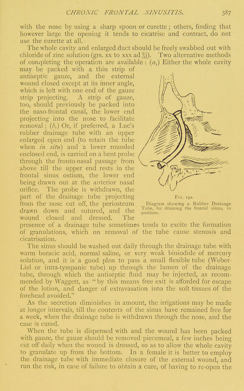 with the nose by using a sharp spoon or curette; others, finding that however large the opening it tends to cicatrise and contract, do not use the curette at all. The whole cavity and enlarged duct should be freely swabbed out with chloride of zinc solution (grs. xx to xxx ad 5]). Two alternative methods of conipleting the operation are available : (a,) Either the whole cavity may be packed with a thin strip of antiseptic gauze, and the external wound closed except at its inner angle, which is left with one end of the gauze strip projecting. A strip of gauze, too, should previously be packed into the naso-frontal canal, the lower end projecting into the nose to facilitate removal; (/;,) Or, if preferred, a Luc's rubber drainage tube with an upper enlarged open end (to retain the tube when /;/ situ) and a lower rounded enclosed end, is carried on a bent probe through the fronto-nasal passage from above till the upper end rests in the frontal sinus ostium, the lower end being drawn out at the anterior nasal orifice. The probe is withdrawn, the part of the drainage tube projecting from the nose cut off, the periosteum Diagram showing a Rubber Drainage J J 1 <. J J i-u Tube, for draining the frontal sinus, in drawn down and sutured, and the position, wound closed and dressed. The presence of a drainage tube sometimes tends to excite the formation of granulations, which on removal of the tube cause stenosis and cicatrisation. The sinus should be washed out daily through the drainage tube with warm boracic acid, normal saline, or very weak biniodide of mercury solution, and it is a good plan to pass a small flexible tube (Weber- Liel or intra-tympanic tube) up through the lumen of the drainage tube, through which the antiseptic fluid may be injected, as recom- mended by Waggett, as  by this means free exit is afforded for escape of the lotion, and danger of extravasation into the soft tissues of the forehead avoided. As the secretion diminishes in amount, the irrigations may be made at longer intervals, till the contents of the sinus have remained free for a week, when the drainage tube is withdrawn through the nose, and the case is cured. When the tube is dispensed with and the wound has been packed with gauze, the gauze should be removed piecemeal, a few inches being cut off daily when the wound is dressed, so as to allow the whole cavity to granulate up from the bottom. In a female it is better to employ the drainage tube with immediate closure of the external wound, and run the risk, in case of failure to obtain a cure, of having to re-open the Fig. 192.