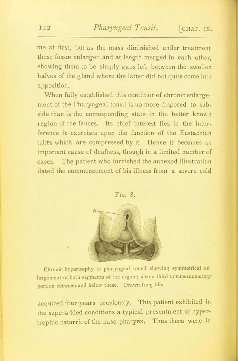 me at first, but as the mass diminished under treatment these fosScE enlarged and at length merged in each other, showing them to be simply gaps left between the swollen halves of the gland where the latter did not quite come into apposition. When fully established this condition of chronic enlarge- ment of the Pharyngeal tonsil is no more disposed to sub- side than is the corresponding state in the better known region of the fauces. Its chief interest lies in the inter- ference it exercises upon the function of the Eustachian tubes which are compressed by it. Hence it becomes an important cause of deafness, though in a limited number of cases. The patient who furnished the annexed illustration dated the commencement of his illness from a severe cold Fig. 8. A-,:: Chronic hypertrophy of pharyngeal tonsil showing symmetrical en- largement ot both segments of the organ ; also a third or supernumerary portion between and below these. Drawn froiy life. acquired four years previously. This patient exhibited in the superadded conditions a typical presentment of hyper- trophic catarrh of the naso-pharynx. Thus there were in