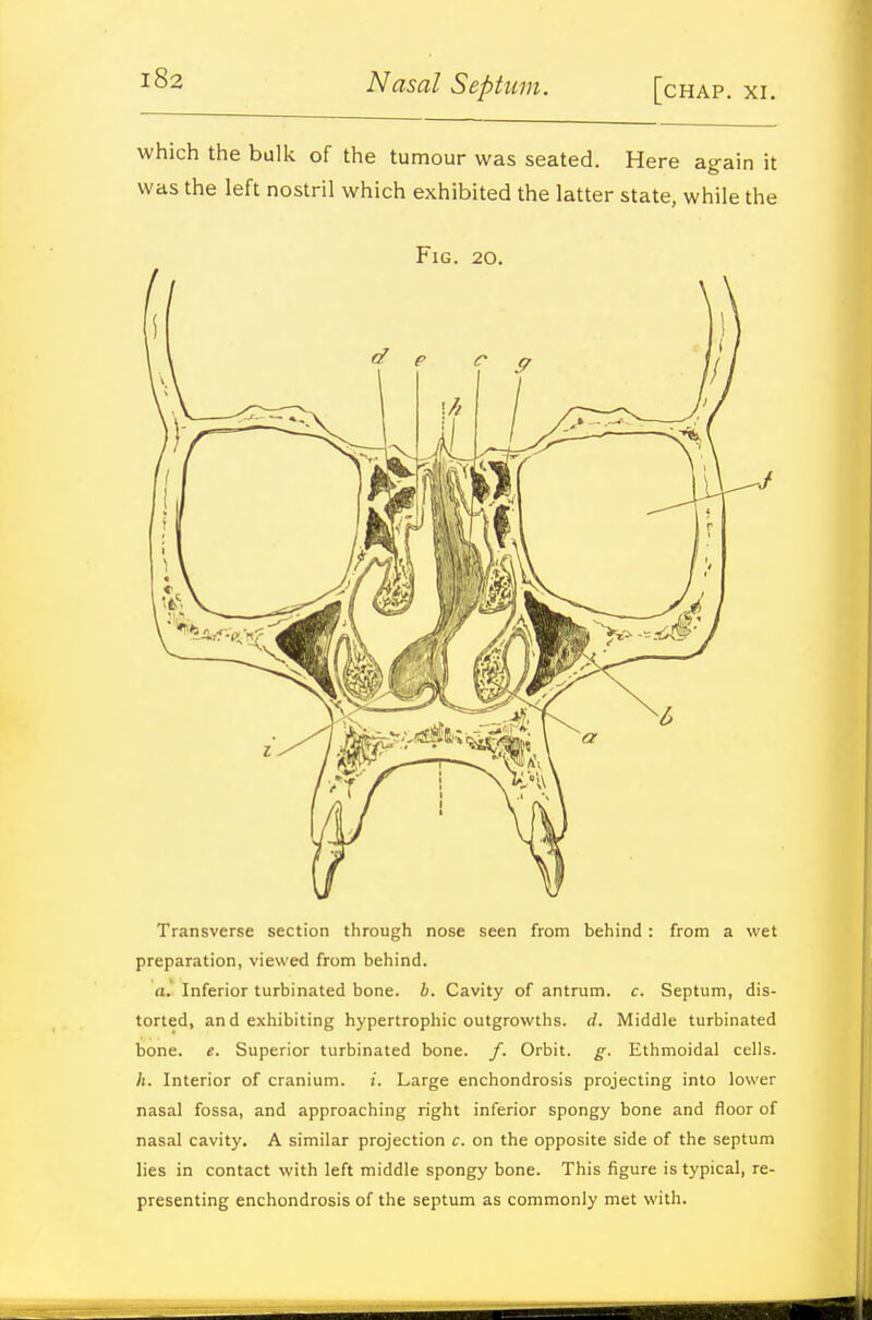 which the bulk of the tumour was seated. Here again it was the left nostril which exhibited the latter state, while the Fig. 20. Transverse section through nose seen from behind: from a wet preparation, viewed from behind. a.' Inferior turbinated bone. b. Cavity of antrum, c. Septum, dis- torted, an d exhibiting hypertrophic outgrowths, d. Middle turbinated bone. e. Superior turbinated bone. Orbit, g. Ethmoidal cells. h. Interior of cranium, i. Large enchondrosis projecting into lower nasal fossa, and approaching right inferior spongy bone and floor of nasal cavity. A similar projection c. on the opposite side of the septum lies in contact with left middle spongy bone. This figure is typical, re- presenting enchondrosis of the septum as commonly met with.