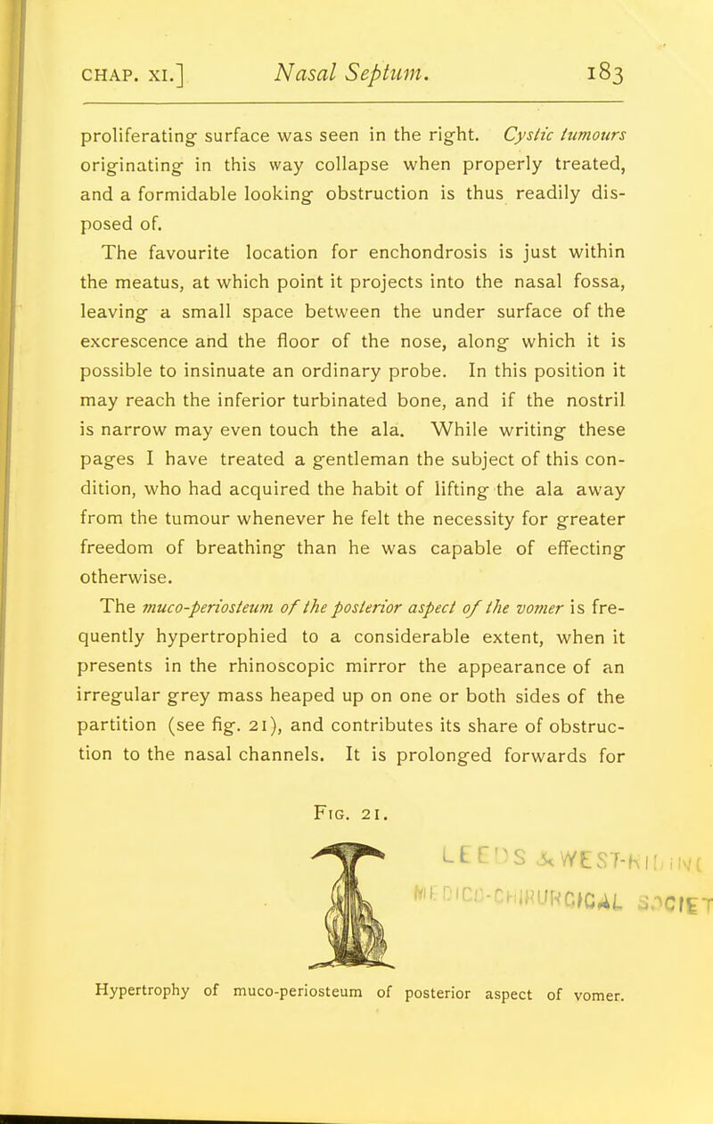 proliferating surface was seen in the right. Cyslic tumours originating in this way collapse when properly treated, and a formidable looking obstruction is thus readily dis- posed of. The favourite location for enchondrosis is just within the meatus, at which point it projects into the nasal fossa, leaving a small space between the under surface of the excrescence and the floor of the nose, along which it is possible to insinuate an ordinary probe. In this position it may reach the inferior turbinated bone, and if the nostril is narrow may even touch the ala. While writing these pages I have treated a gentleman the subject of this con- dition, who had acquired the habit of lifting the ala away from the tumour whenever he felt the necessity for greater freedom of breathing than he was capable of effecting otherwise. The muco-periosteum of the posterior aspect 0/ the vomer is fre- quently hypertrophied to a considerable extent, when it presents in the rhinoscopic mirror the appearance of an irregular grey mass heaped up on one or both sides of the partition (see fig. 21), and contributes its share of obstruc- tion to the nasal channels. It is prolonged forwards for Hypertrophy of muco-periosteum of posterior aspect of vomer.