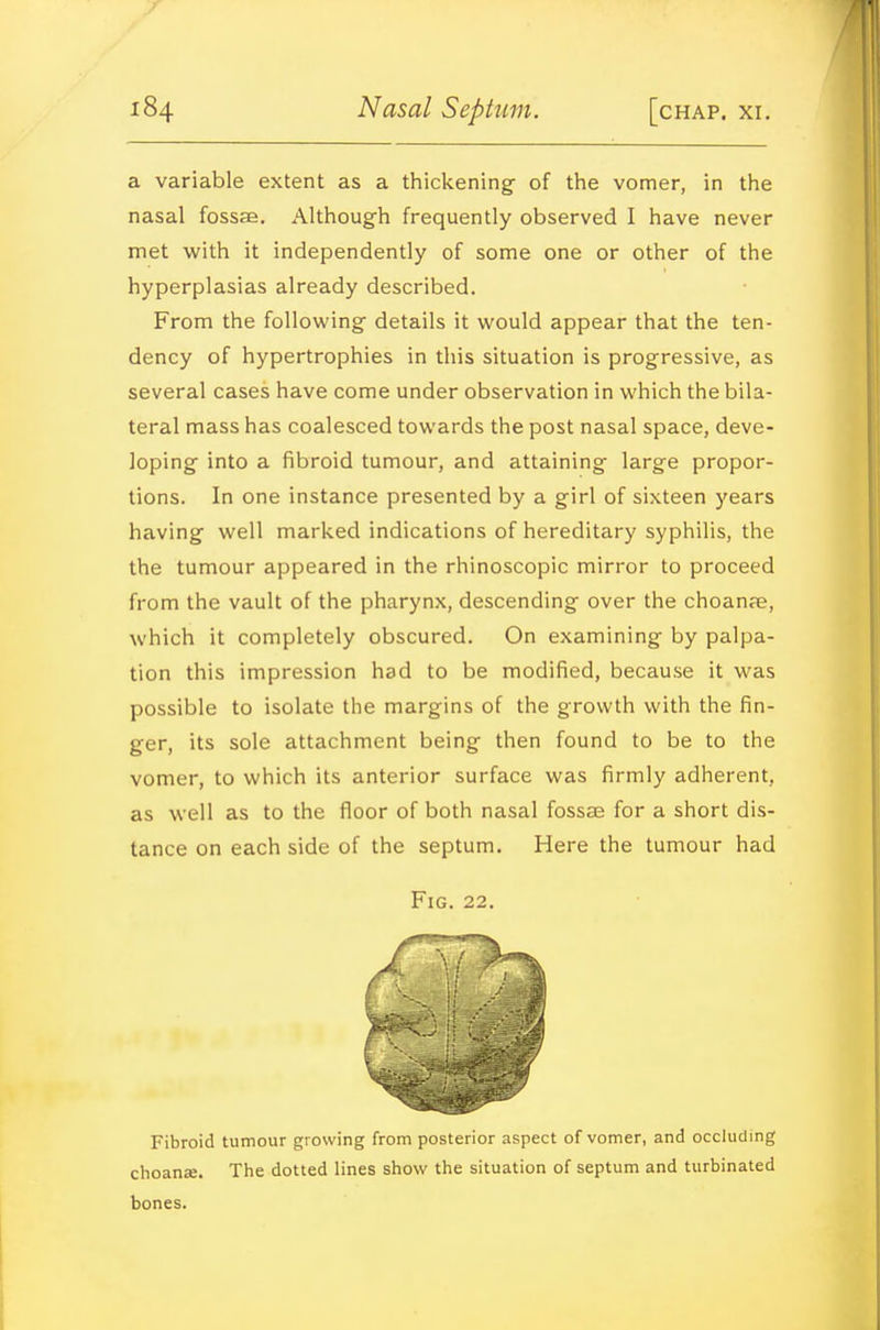 a variable extent as a thickening- of the vomer, in the nasal fossae. Although frequently observed I have never met with it independently of some one or other of the hyperplasias already described. From the following details it would appear that the ten- dency of hypertrophies in this situation is progressive, as several cases have come under observation in which the bila- teral mass has coalesced towards the post nasal space, deve- loping into a fibroid tumour, and attaining large propor- tions. In one instance presented by a girl of sixteen 5'ears having well marked indications of hereditary syphilis, the the tumour appeared in the rhinoscopic mirror to proceed from the vault of the pharynx, descending over the choanae, which it completely obscured. On examining by palpa- tion this impression had to be modified, because it was possible to isolate the margins of the growth with the fin- ger, its sole attachment being then found to be to the vomer, to which its anterior surface was firmly adherent, as well as to the floor of both nasal fossae for a short dis- tance on each side of the septum. Here the tumour had Fibroid tumour growing from posterior aspect of vomer, and occluding choanse. The dotted lines show the situation of septum and turbinated bones.