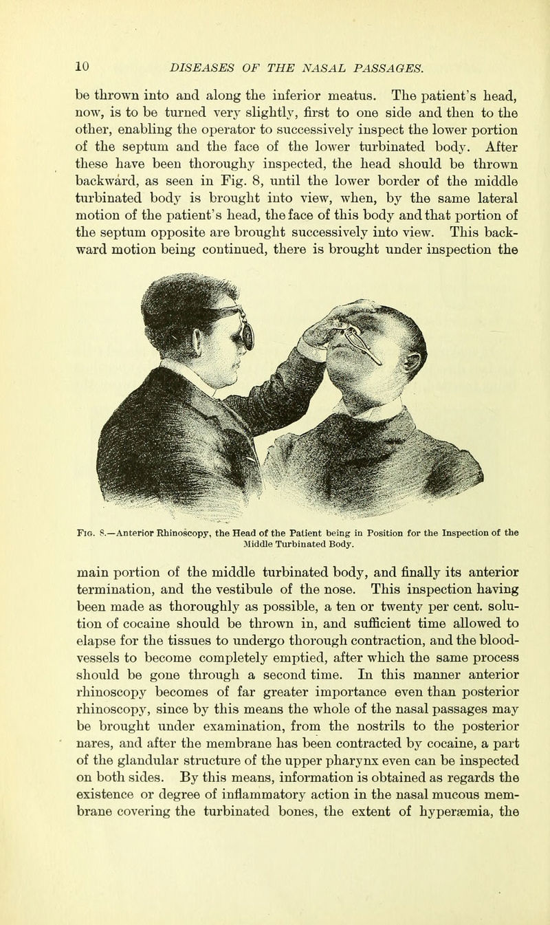 be thrown into and along the inferior meatus. The patient's head, now, is to be turned very slightly, first to one side and then to the other, enabling the operator to successively inspect the lower portion of the septum and the face of the lower turbinated body. After these have been thoroughy inspected, the head should be thrown backward, as seen in Fig. 8, until the lower border of the middle turbinated body is brought into view, when, by the same lateral motion of the patient's head, the face of this body and that portion of the septum opposite are brought successively into view. This back- ward motion being continued, there is brought under inspection the Fig. 8.—Anterior Ehinoscopy, the Head of the Patient being in Position for the Inspection of the Middle Turbinated Body. main portion of the middle turbinated body, and finally its anterior termination, and the vestibule of the nose. This inspection having been made as thoroughly as possible, a ten or twenty per cent, solu- tion of cocaine should be thrown in, and sufiicient time allowed to elapse for the tissues to undergo thorough contraction, and the blood- vessels to become completely emptied, after which the same process should be gone through a second time. In this manner anterior rhinoscopy becomes of far greater importance even than posterior rhinoscopy, since by this means the whole of the nasal passages may be brought under examination, from the nostrils to the posterior nares, and after the membrane has been contracted by cocaine, a part of the glandular structure of the upper pharynx even can be inspected on both sides. By this means, information is obtained as regards the existence or degree of inflammatory action in the nasal mucous mem- brane covering the turbinated bones, the extent of hyperaemia, the