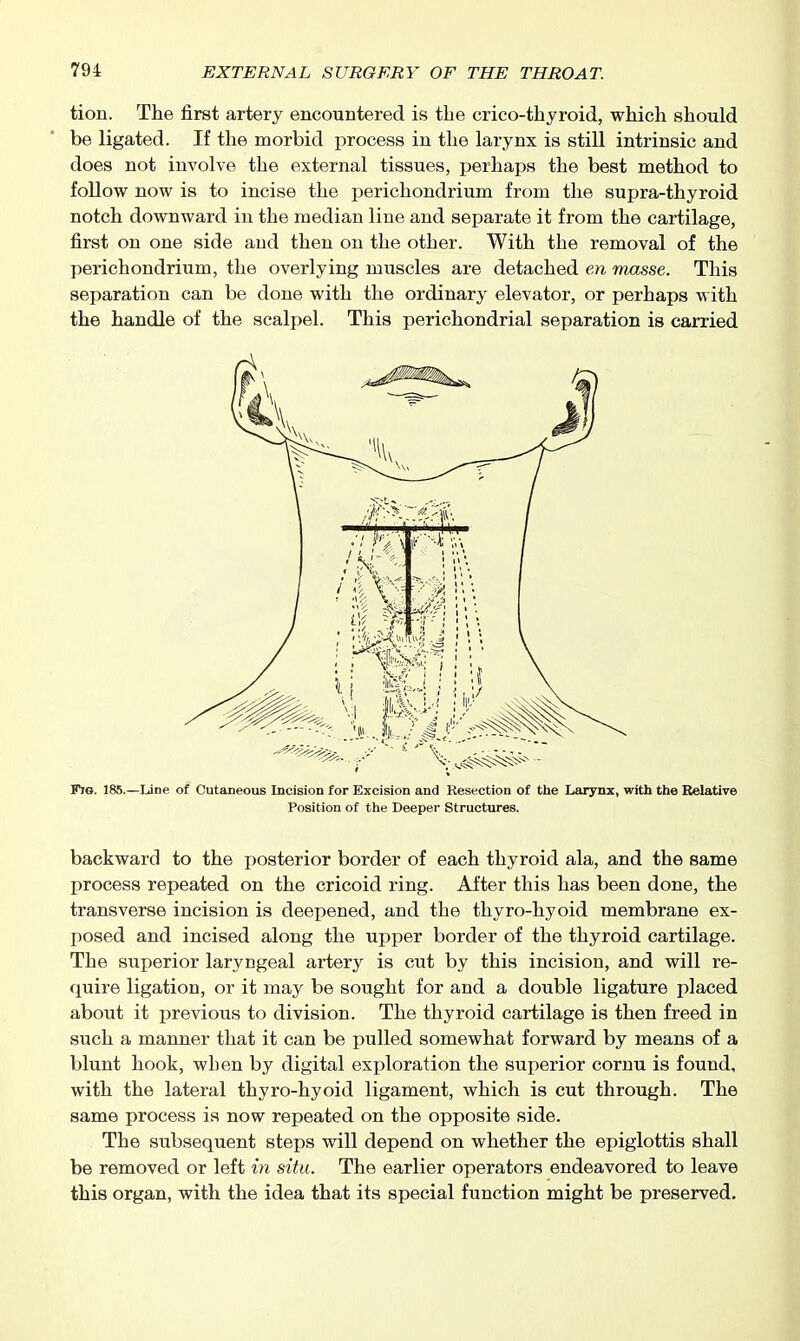 tion. The first artery encountered is tLe crico-thyroid, which should be ligated. If the morbid process in the larynx is still intrinsic and does not involve the external tissues, perhaps the best method to follow now is to incise the perichondrium from the supra-thyroid notch downward in the median line and separate it from the cartilage, first on one side and then on the other. With the removal of the perichondrium, the overlying muscles are detached eyi masse. This separation can be done with the ordinary elevator, or perhaps with the handle of the scalpel. This perichondrial separation is carried Fjg. 185.—Line of Cutaneous Incision for Excision and Resection of the Larynx, with the Relative Position of the Deeper Structures. backward to the posterior border of each thyroid ala, and the same process repeated on the cricoid ring. After this has been done, the transverse incision is deepened, and the thyro-hyoid membrane ex- posed and incised along the upper border of the thyroid cartilage. The superior laryngeal artery is cut by this incision, and will re- quire ligation, or it may be sought for and a double ligature placed about it previous to division. The thyroid cartilage is then freed in such a manner that it can be pulled somewhat forward by means of a blunt hook, when by digital exploration the superior cornu is found, with the lateral thyro-hyoid ligament, which is cut through. The same process is now repeated on the opposite side. The subsequent steps will depend on whether the epiglottis shall be removed or left in situ. The earlier operators endeavored to leave this organ, with the idea that its special function might be preserved.