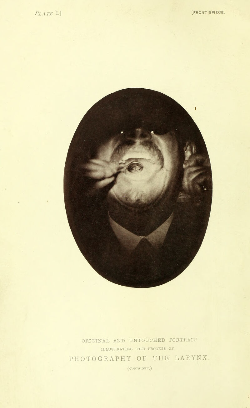 Plate I] [FRONTISPIECE. ORIGINAL AND UNTOUCHED PORTRAir ILLUSTRATING THE PROCESS OF PHOTOGRAPHY OF THE LARYNX. (COPrRIQST,)