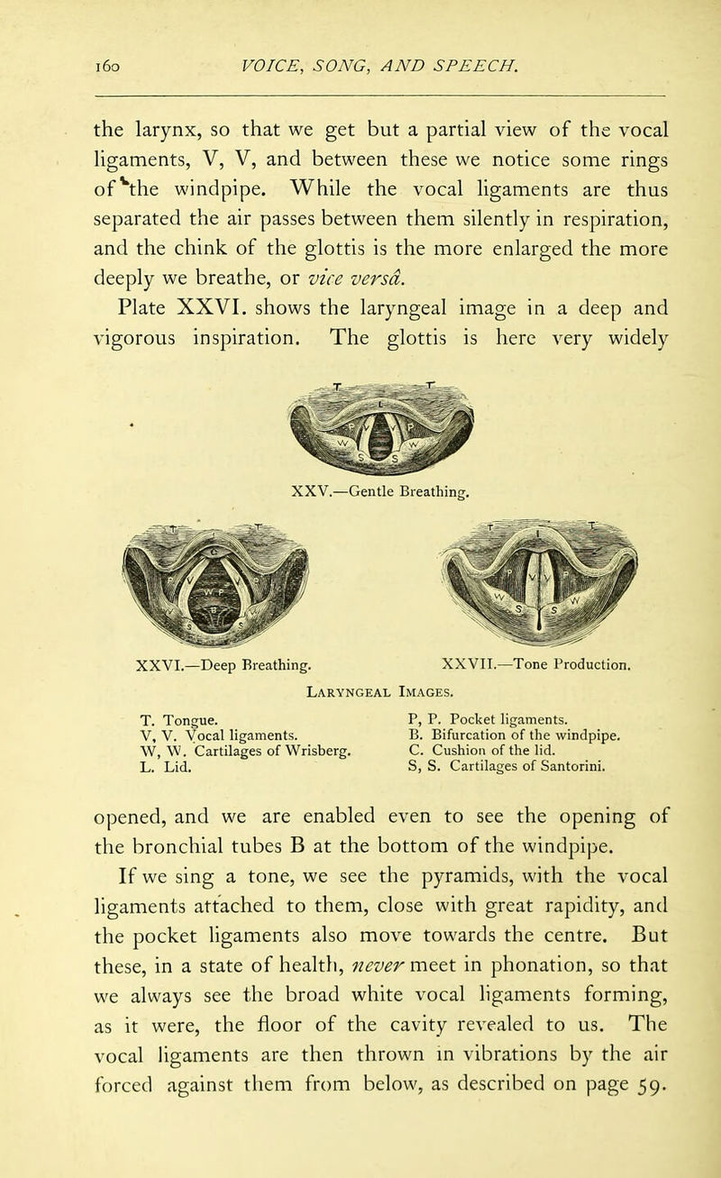 the larynx, so that we get but a partial view of the vocal ligaments, V, V, and between these we notice some rings of^he windpipe. While the vocal ligaments are thus separated the air passes between them silently in respiration, and the chink of the glottis is the more enlarged the more deeply we breathe, or vice versa. Plate XXVI. shows the laryngeal image in a deep and vigorous inspiration. The glottis is here very widely XXVI.—Deep Breathing. XXVII.—Tone Production. Laryngeal Images. T. Tongue. P, P. Pocket ligaments. V, v. Vocal ligaments. B. Bifurcation of the windpipe. W, W. Cartilages of Wrisberg. C. Cushion of the lid. L. Lid. S, S. Cartilages of Santorini. opened, and we are enabled even to see the opening of the bronchial tubes B at the bottom of the windpipe. If we sing a tone, we see the pyramids, with the vocal ligaments attached to them, close with great rapidity, and the pocket ligaments also move towards the centre. But these, in a state of health, never mttt in phonation, so that we always see the broad white vocal ligaments forming, as it were, the floor of the cavity revealed to us. The vocal ligaments are then thrown m vibrations by the air forced against them from below, as described on page 59.