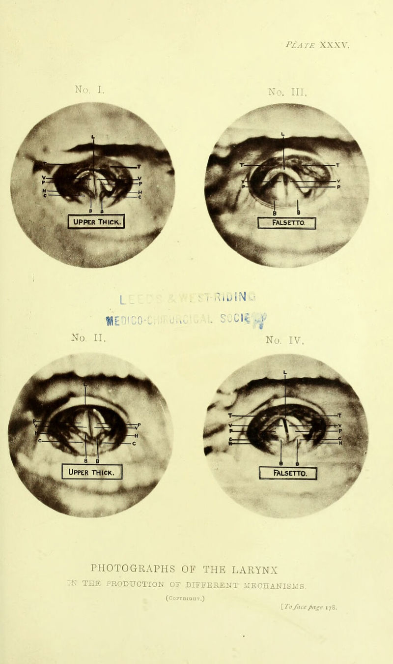 Plate XXXV. No. I, Na III. PHOTOGRAPHS OF THE LARYNX IN THE PfiODUCTION OF DIFFERENT MECHANISMS. (CoPrRIOHT.) \,To face page 178.