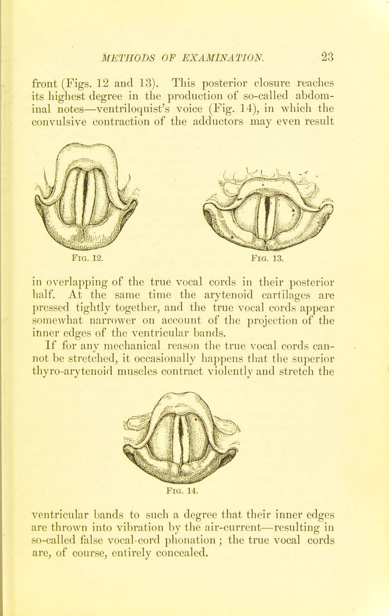 front (Figs. 12 and 13). This posterior closure reaches its highest degree in the production of so-called abdom- inal notes—ventriloquist's voice (Fig. 14), in which the convulsive contraction of the adductors may even result Fig. 12. Fig. 13. in overlapping of the true vocal cords in their posterior half. At the same time the arytenoid cartilages are pressed tightly together, and the true vocal cords appear somewhat narrower on account of the projection of the inner edges of the ventricular bands. If for any mechanical reason the true vocal cords can- not be stretched, it occasionally happens that the superior thyro-arytenoid muscles contract violently and stretch the Fig. 14. ventricular bands to such a degree that their inner edges are thrown into vibration by the air-current—resulting in so-called false vocal-cord phonation ; the true vocal cords are, of course, entirely concealed.