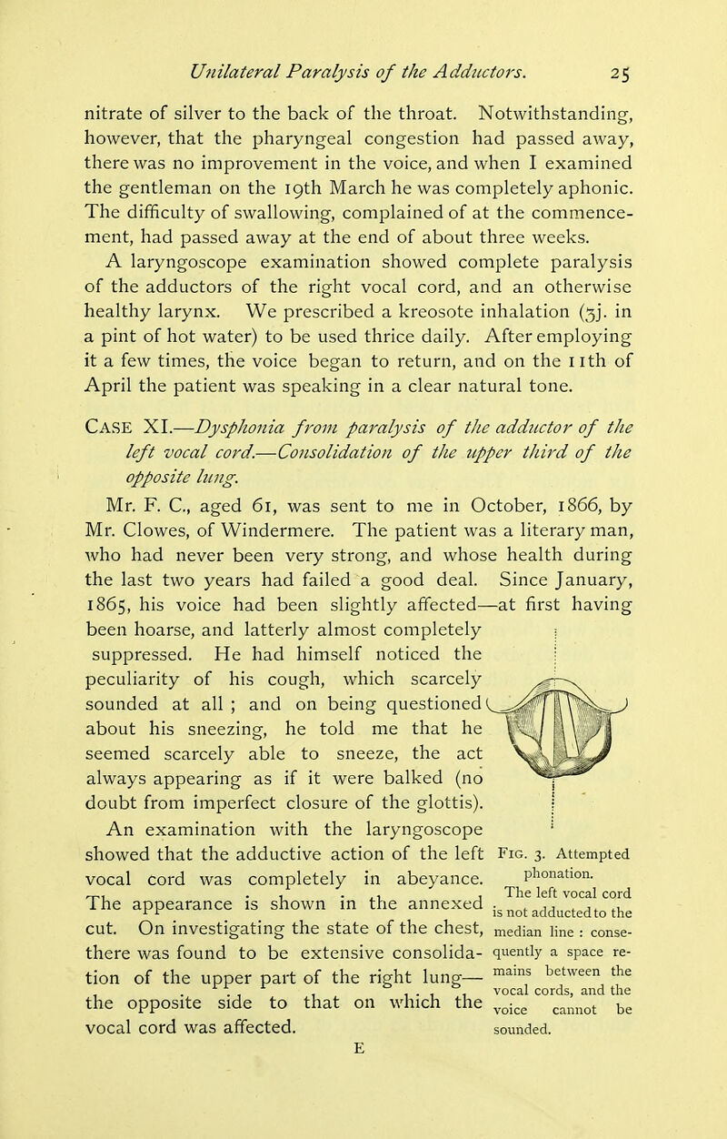 nitrate of silver to the back of the throat. Notwithstanding, however, that the pharyngeal congestion had passed away, there was no improvement in the voice, and when I examined the gentleman on the 19th March he was completely aphonic. The difficulty of swallowing, complained of at the commence- ment, had passed away at the end of about three weeks. A laryngoscope examination showed complete paralysis of the adductors of the right vocal cord, and an otherwise healthy larynx. We prescribed a kreosote inhalation (5]. in a pint of hot water) to be used thrice daily. After employing it a few times, the voice began to return, and on the nth of April the patient was speaking in a clear natural tone. Case XL—Dysphonia from paralysis of the adductor of the left vocal cord.—Consolidation of the upper third of the opposite lung. Mr. F. C, aged 61, was sent to me in October, 1866, by Mr. Clowes, of Windermere. The patient was a literary man, who had never been very strong, and whose health during the last two years had failed a good deal. Since January, 1865, his voice had been slightly affected—at first having been hoarse, and latterly almost completely ; suppressed. He had himself noticed the i peculiarity of his cough, which scarcely sounded at all ; and on being questioned 1 about his sneezing, he told me that he seemed scarcely able to sneeze, the act always appearing as if it were balked (no doubt from imperfect closure of the glottis). | An examination with the laryngoscope ' showed that the adductive action of the left Fig. 3. Attempted vocal cord was completely in abeyance. phonation. . , . ,, , The left vocal cord The appearance is shown m the annexed i^notadductedto the cut. On investigating the state of the chest, median Hne : conse- there was found to be extensive consolida- quently a space ra- tion of the upper part of the right lung— ^^'f ^^^'^^^^^ . . , , . , , vocal cords, and the the opposite side to that on which the ^^^^^ ^^^.^^^ ^e vocal cord was affected, sounded. E