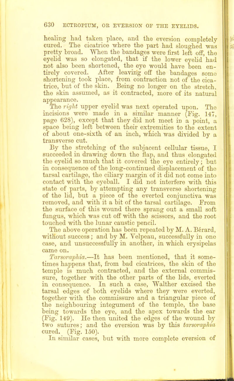 healing had taken place, and the oversion completely cured. The cicatrice where the part had sloughed was pretty broad. When the bandages were first left off, tho eyelid was so elongated, that if the lower eyelid had not also been shortened, the eye would have been en- tirely covered. After leaving off the bandages some shortening took place, from contraction not of the cica- trice, but of the skin. Being no longer on the stretch, the skin assumed, as it contracted, more of its natural appearance. The right upper eyelid was next operated upon. Tho incisions were made in a similar manner (Fig. 147, page (i28), except that they did not meet in a point, a spaco being left between their extremities to the extent of about one-sixth of an inch, which was divided by a transverse cut. By tho stretching of tho subjacent cellular tissue, I succeeded in drawing down tho Hap, and thus elongated the eyelid so much that it covered the eye entirely; but in consequence of tho long-continued displacement of the tarsal cartilage, the ciliary margin of it did not come into contact with tho eyeball. I did not interfere with this state of parts, by attempting any transverse shortening of tho lid, but a piece of the overtcd conjunctiva was romoved, and with it a bit of the tarsal cartilage. From tho surfaco of this wound thero sprang out a small soft fungus, which was cut off with the scissors, and the root touched with tho lunar caustic pencil. Tho above operation has been repeated by M. A. Berard, without success ; and by M. Volpeau, successfully in one case, and unsuccessfully in another, in which erysipelas came on. Tarsoi-aphia.—It has been mentioned, that it some- times happens that, from bad cicatrices, the skin of tho temple is much contracted, and the external commis- sure, together with the other parts of the Hds, everted in consequence. In such a case, Walther excised the tarsal edges of both eyeUds where they were everted, together with the commissure and a triangular piece of the neighbom-ing integument of the temple, the baso being towards the eye, and the apex towards the ear (Fig. 149). He then united the edges of the wound by two sutures; and the eversion was by this tarsoraplria cured. (Fig. 150). In similar cases, but with more complete eversion of