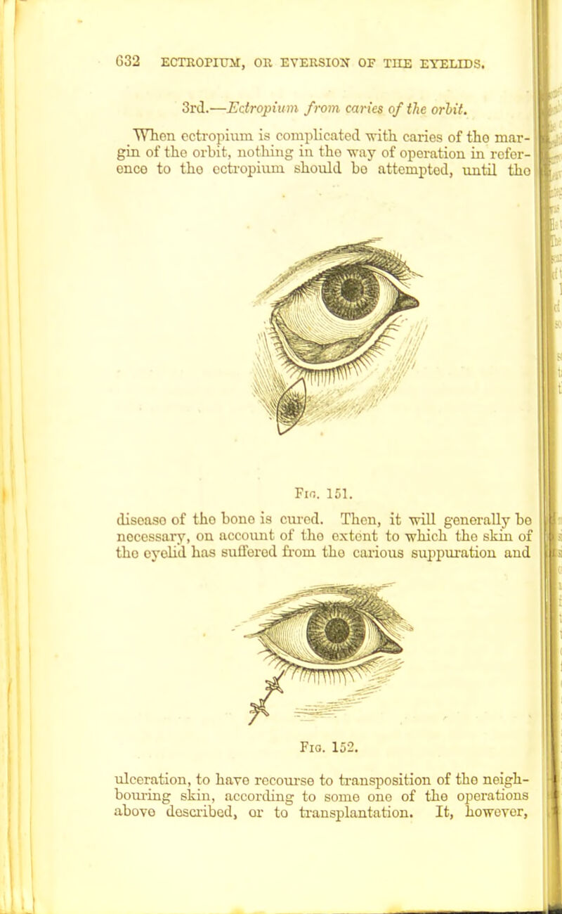 3rd.—Edropium from caries of the orbit. When eotropium is complicated with caries of tho mar- gin of the orbit, nothing in the way of operation in refer- ence to tho ectropium should bo attempted, until tho Fin. 151. diseaso of tho bono is cured. Then, it will generally be necessary, on account of tho extent to which the skin of tho eyelid has suffered from tho carious suppuration and ulceration, to have recourse to transposition of tbo neigh- bouring skin, according to some one of the operations above described, or to transplantation. It, however,