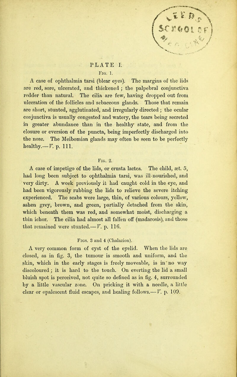 Fig. 1. A case of ophthalmia tarsi (blear eyes). The margins of the lids are red, sore, ulcerated, and thickened ; the palpebral conjunctiva redder than natural. The cilia are few, having dropped out from ulceration of the follicles and sebaceous glands. Those that remain are short, stunted, agglutinated, and irregularly directed ; the ocular conjunctiva is usually congested and watery, the tears being secreted in greater abundance than in the healthy state, and from the closure or eversion of the puncta, being imperfectly discharged into the nose. The Meibomian glands may often be seen to be perfectly healthy.—r. p. 111. Fig. 2. A case of impetigo of the lids, or crusta laotea. The child, set. 5, had long been subject to ophthalmia tarsi, was ill-nourished, and very dirty. A week previously it had caught cold in the eye, and had been vigorously rubbing the lids to relieve the severe itching experienced. The scabs were large, thin, of various colours, yellow, ashen grey, brown, and green, partially detached from the skin, which beneath them was red, and somewhat moist, discharging a thin ichor. The cilia had almost all fallen off (madarosis), and those that remained were stunted.— V. p. 116. Figs. 3 and 4 (Chalazion). A very common form of cyst of the eyelid. When the lids are closed, as in fig. 3, the tumour is smooth and uniform, and the skin, which in the early stages is freely moveable, is in'no way discoloured; it is hard to the touch. On everting the lid a small bluish spot is perceived, not quite so defined as in fig. 4, surrounded by a little vascular zone. On pricking it with a needle, a little clear or opalescent fluid escapes, and healing follows.—V. p. 109.