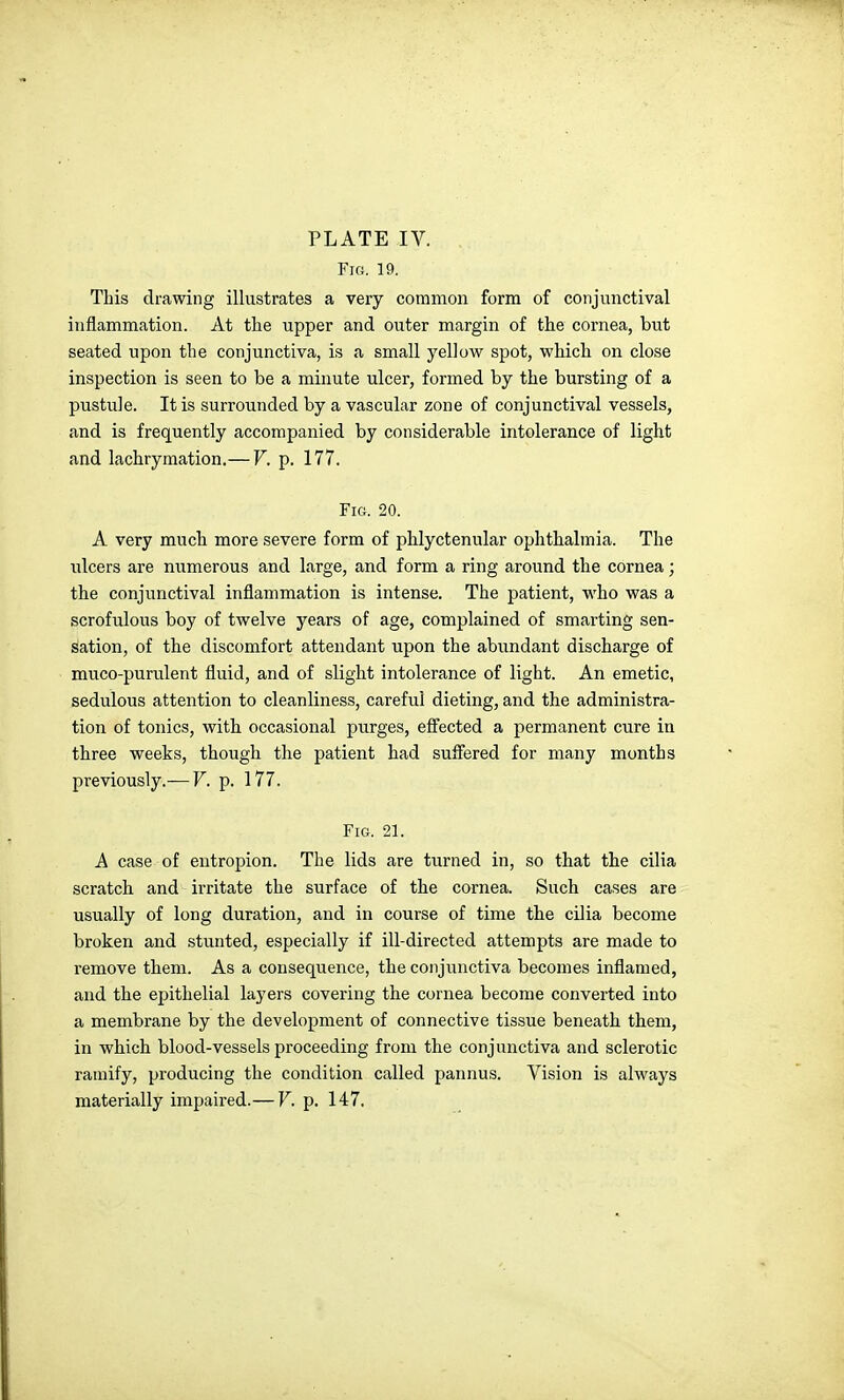 Fig. 19. This drawing illustrates a very common form of conjunctival inflammation. At the upper and outer margin of the cornea, but seated upon the conjunctiva, is a small yellow spot, which on close inspection is seen to be a minute ulcer, formed by the bursting of a pustule. It is surrounded by a vascular zone of conjunctival vessels, and is frequently accompanied by considerable intolerance of light and lachrymation.— V. p. 177. Fig. 20. A very much more severe form of phlyctenular ophthalmia. The ulcers are numerous and large, and form a ring around the cornea; the conjunctival inflammation is intense. The patient, who was a scrofulous boy of twelve years of age, complained of smarting sen- sation, of the discomfort attendant upon the abundant discharge of mvico-purulent fluid, and of slight intolerance of light. An emetic, sedulous attention to cleanliness, careful dieting, and the administra- tion of tonics, with occasional purges, effected a permanent cure in three weeks, though the patient had suffered for many months previously.— V. p. 177. Fig. 21. A case of entropion. The lids are turned in, so that the cilia scratch and irritate the surface of the cornea. Such cases are usually of long duration, and in course of time the cilia become broken and stunted, especially if ill-directed attempts are made to remove them. As a consequence, the conjunctiva becomes inflamed, and the epithelial layers covering the cornea become converted into a membrane by the development of connective tissue beneath them, in which blood-vessels proceeding from the conjunctiva and sclerotic ramify, producing the condition called pannus. Vision is always materially impaired.— V. p. 147.