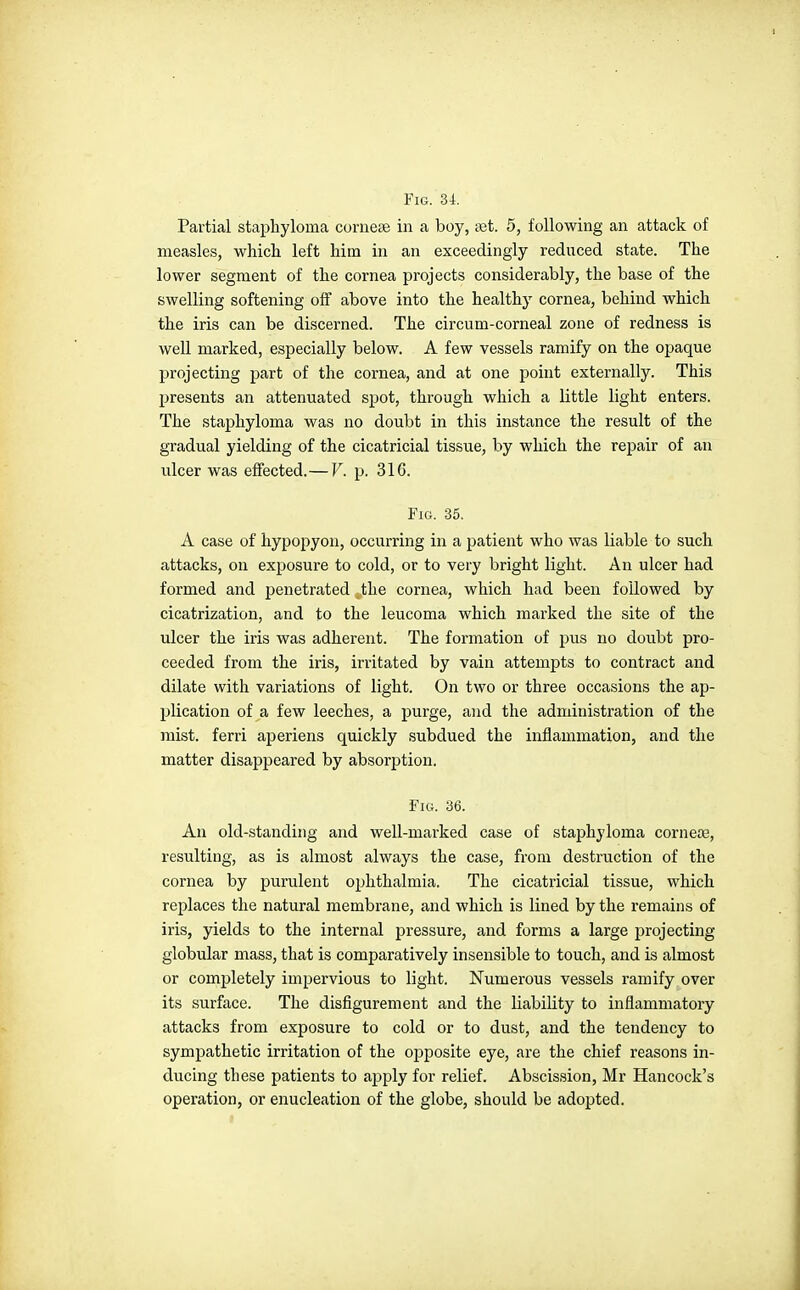Partial staphyloma cornese in a boy, ast. 5, following an attack of measles, whicli left him in an exceedingly reduced state. The lower segment of the cornea projects considerably, the base of the swelling softening off above into the healthy cornea, behind which the iris can be discerned. The circum-corneal zone of redness is well marked, especially below. A few vessels ramify on the opaque projecting part of the cornea, and at one point externally. This presents an attenuated spot, through which a little light enters. The staphyloma was no doubt in this instance the result of the gradual yielding of the cicatricial tissue, by which the repair of an ulcer was effected.— V. p. 316. Fig. 35. A case of hypopyon, occurring in a patient who was liable to such attacks, on exposure to cold, or to very bright light. An ulcer had formed and penetrated the cornea, which had been followed by cicatrization, and to the leucoma which marked the site of the ulcer the iris was adherent. The formation of pus no doubt pro- ceeded from the iris, irritated by vain attempts to contract and dilate with variations of light. On two or three occasions the ap- plication of a few leeches, a purge, and the administration of the mist, ferri aperiens quickly subdued the inflammation, and the matter disappeared by absorption. Fig. 36. An old-standing and well-marked case of staphyloma corneJB, resulting, as is almost always the case, from destruction of the cornea by purulent ophthalmia. The cicatricial tissue, which replaces the natural membrane, and which is lined by the remains of iris, yields to the internal pressure, and forms a large projecting globular mass, that is comparatively insensible to touch, and is almost or completely impervious to light. Numerous vessels ramify over its surface. The disfigurement and the liability to inflammatory attacks from exposure to cold or to dust, and the tendency to sympathetic irritation of the opposite eye, are the chief reasons in- ducing these patients to apply for relief. Abscission, Mr Hancock's operation, or enucleation of the globe, should be adopted.