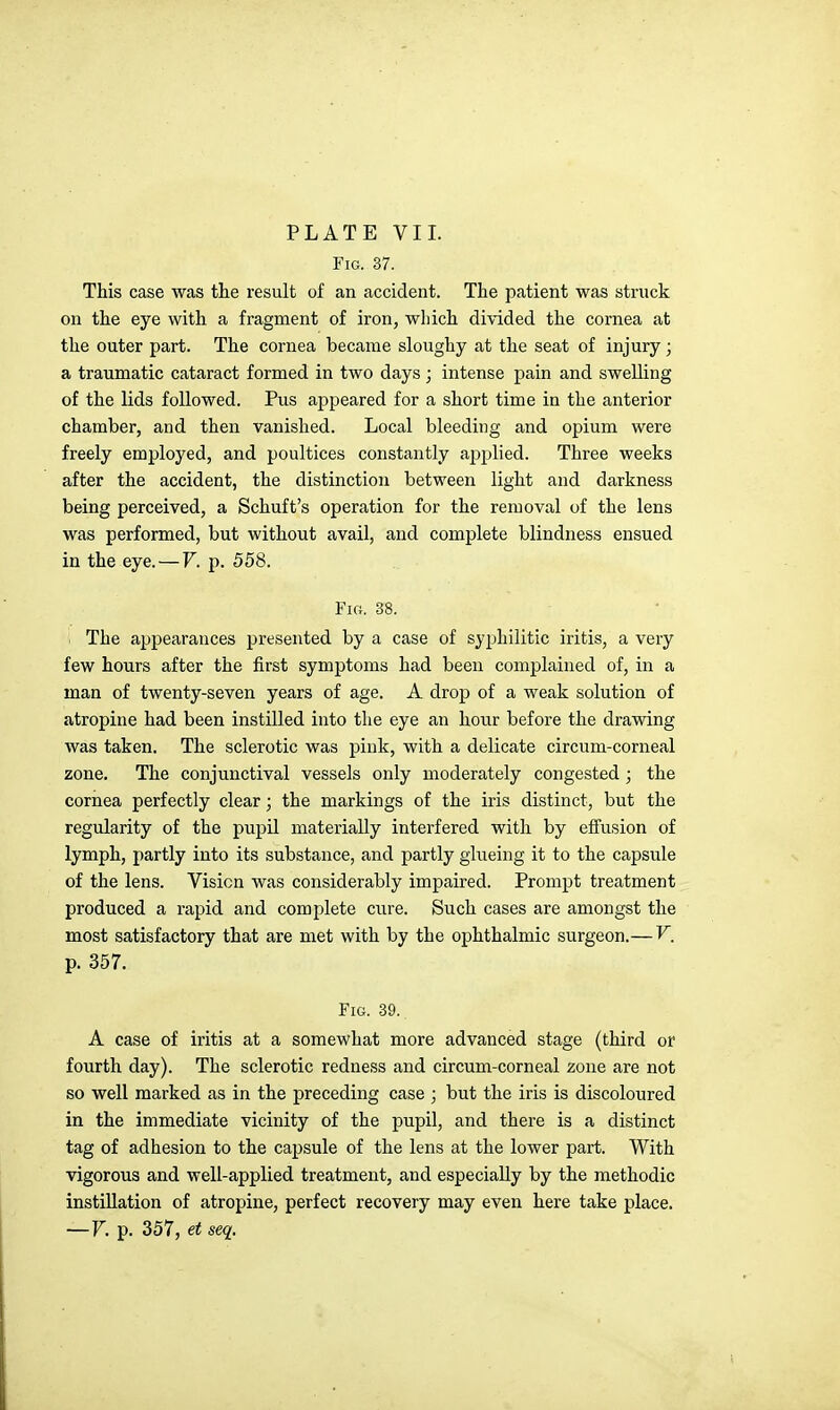 PLATE VII. Fig. 37. This case was the result of an accident. The patient was struck on the eye with a fragment of iron, which divided the cornea at the outer part. The cornea became sloughy at the seat of injury; a traumatic cataract formed in two days ; intense pain and swelling of the lids followed. Pus appeared for a short time in the anterior chamber, and then vanished. Local bleeding and opium were freely employed, and poultices constantly applied. Three weeks after the accident, the distinction between light and darkness being perceived, a Schuft's operation for the removal of the lens was performed, but without avail, and complete blindness ensued in the eye.—V. p. 558. Fig. 38. 1 The appearances presented by a case of syphilitic iritis, a very few hours after the first symptoms had been complained of, in a man of twenty-seven years of age. A drop of a weak solution of atropine had been instilled into the eye an hour before the drawing was taken. The sclerotic was pink, with a delicate circum-corneal zone. The conjunctival vessels only moderately congested ; the cornea perfectly clear; the markings of the iris distinct, but the regularity of the pupil materially interfered with by effusion of lymph, partly into its substance, and partly glueing it to the capsule of the lens. Vision was considerably impaired. Prompt treatment produced a rapid and complete cure. Such cases are amongst the most satisfactory that are met with by the ophthalmic surgeon.—V, p. 357. Fig. 39. A case of iritis at a somewhat more advanced stage (third or fourth day). The sclerotic redness and circum-corneal zone are not so well marked as in the preceding case ; but the iris is discoloured in the immediate vicinity of the pupil, and there is a distinct tag of adhesion to the capsule of the lens at the lower part. With vigorous and well-applied treatment, and especially by the methodic instillation of atropine, perfect recovery may even here take place. —V. p. 357, et seq.