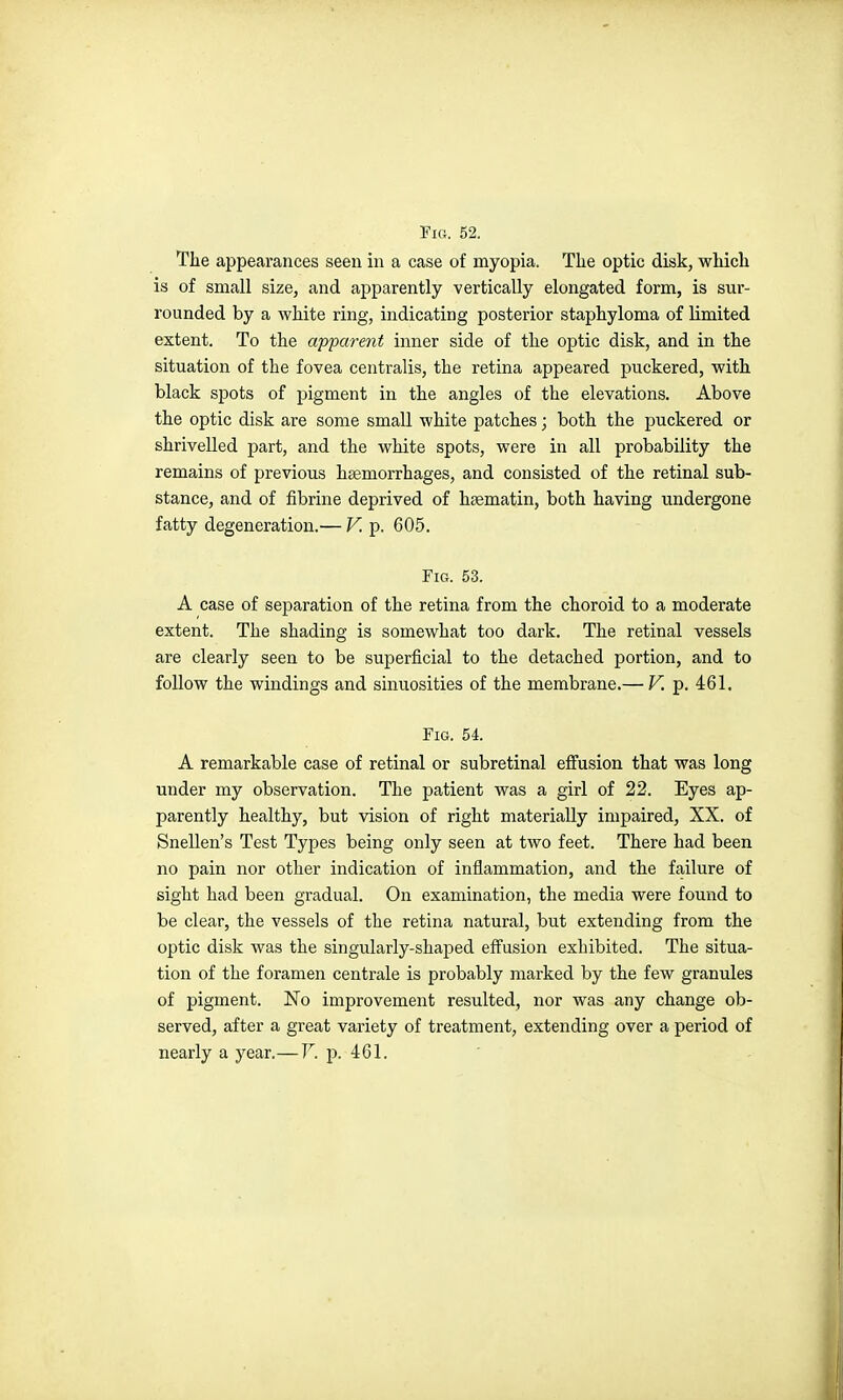Fig. 52. Tlie appearances seen in a case of myopia. Tlie optic disk, which is of small size, and apparently vertically elongated form, is sur- rounded by a white ring, indicating posterior staphyloma of limited extent. To the apparent inner side of the optic disk, and in the situation of the fovea centralis, the retina appeared puckered, with black spots of pigment in the angles of the elevations. Above the optic disk are some small white patches; both the puckered or shrivelled part, and the white spots, were in all probability the remains of previous haemorrhages, and consisted of the retinal sub- stance, and of fibrine deprived of hsematin, both having undergone fatty degeneration.— V. p. 605. Fig. 53. A case of separation of the retina from the choroid to a moderate extent. The shading is somewhat too dark. The retinal vessels are clearly seen to be superficial to the detached portion, and to follow the windings and sinuosities of the membrane.— V. p. 461. Fig. 54. A remarkable case of retinal or subretinal effusion that was long under my observation. The patient was a girl of 22. Eyes ap- parently healthy, but vision of right materially impaired, XX. of Snellen's Test Types being only seen at two feet. There had been no pain nor other indication of inflammation, and the failure of sight had been gradual. On examination, the media were found to be clear, the vessels of the retina natural, but extending from the optic disk was the singularly-shaped effusion exhibited. The situa- tion of the foramen centrale is probably marked by the few granules of pigment. No improvement resulted, nor was any change ob- served, after a great variety of treatment, extending over a period of nearly a year.—Y. j). 461.