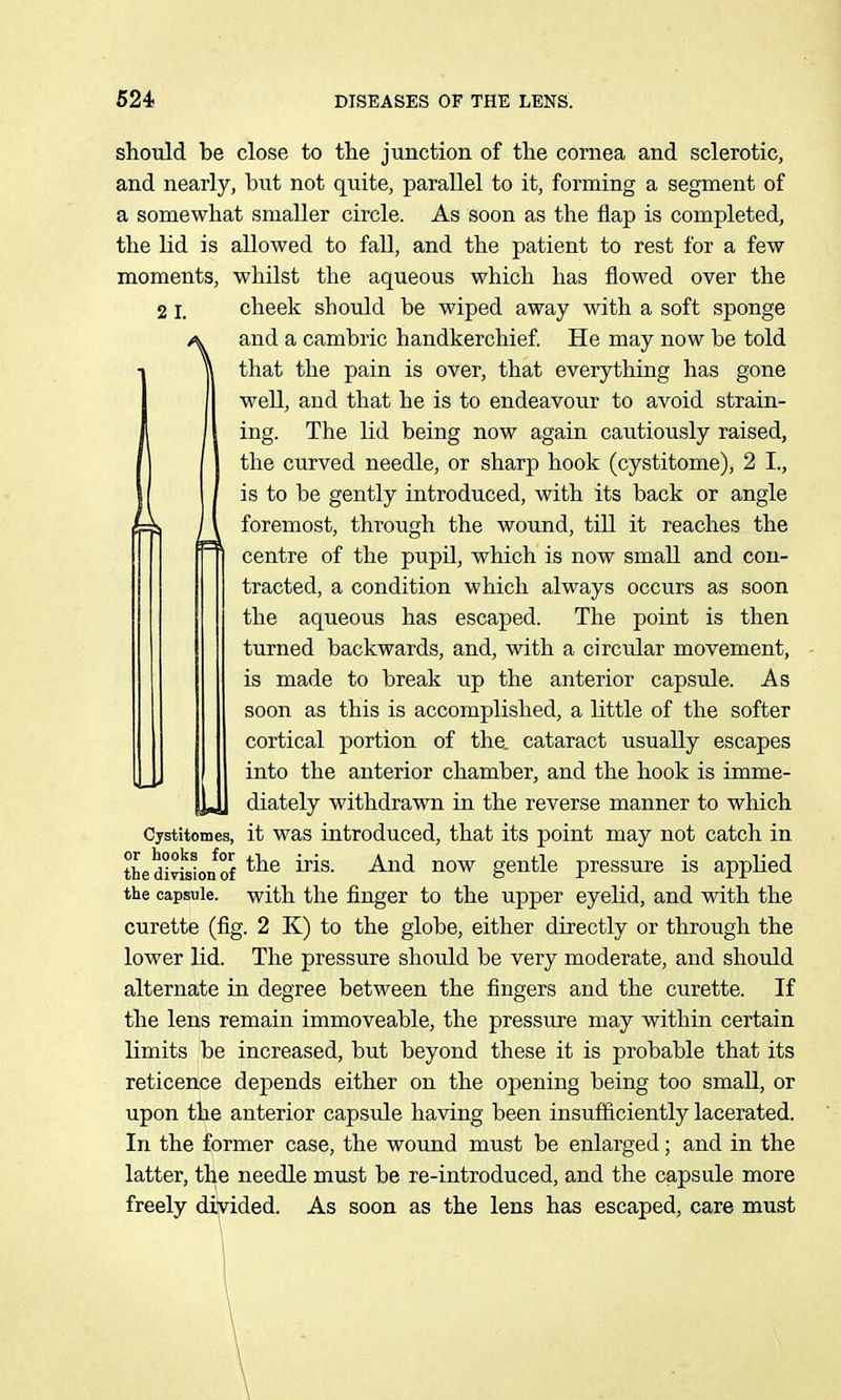2 I. should be close to the junction of the cornea and sclerotic, and nearly, but not quite, parallel to it, forming a segment of a somewhat smaller circle. As soon as the flap is completed, the lid is allowed to fall, and the patient to rest for a few moments, whilst the aqueous which has flowed over the cheek should be wiped away with a soft sponge and a cambric handkerchief He may now be told that the pain is over, that everything has gone well, and that he is to endeavour to avoid strain- ing. The lid being now again cautiously raised, the curved needle, or sharp hook (cystitome), 2 I., is to be gently introduced, with its back or angle ; I foremost, through the wound, till it reaches the centre of the pupil, which is now small and con- tracted, a condition which always occurs as soon the aqueous has escaped. The point is then turned backwards, and, with a circular movement, is made to break up the anterior capsule. As soon as this is accomplished, a little of the softer cortical portion of the. cataract usually escapes into the anterior chamber, and the hook is imme- diately withdrawn in the reverse manner to which it was introduced, that its point may not catch in the iris. And now gentle pressure is applied with the finger to the upper eyelid, and with the curette (fig. 2 K) to the globe, either directly or through the lower lid. The pressure should be very moderate, and should alternate in degree between the fingers and the curette. If the lens remain immoveable, the pressure may within certain limits be increased, but beyond these it is probable that its reticence depends either on the opening being too small, or upon the anterior capsule having been insufiiciently lacerated. In the former case, the wound must be enlarged; and in the latter, the needle must be re-introduced, and the capsule more freely diyided. As soon as the lens has escaped, care must Cystitomes, or hooks for the division of the capsule.