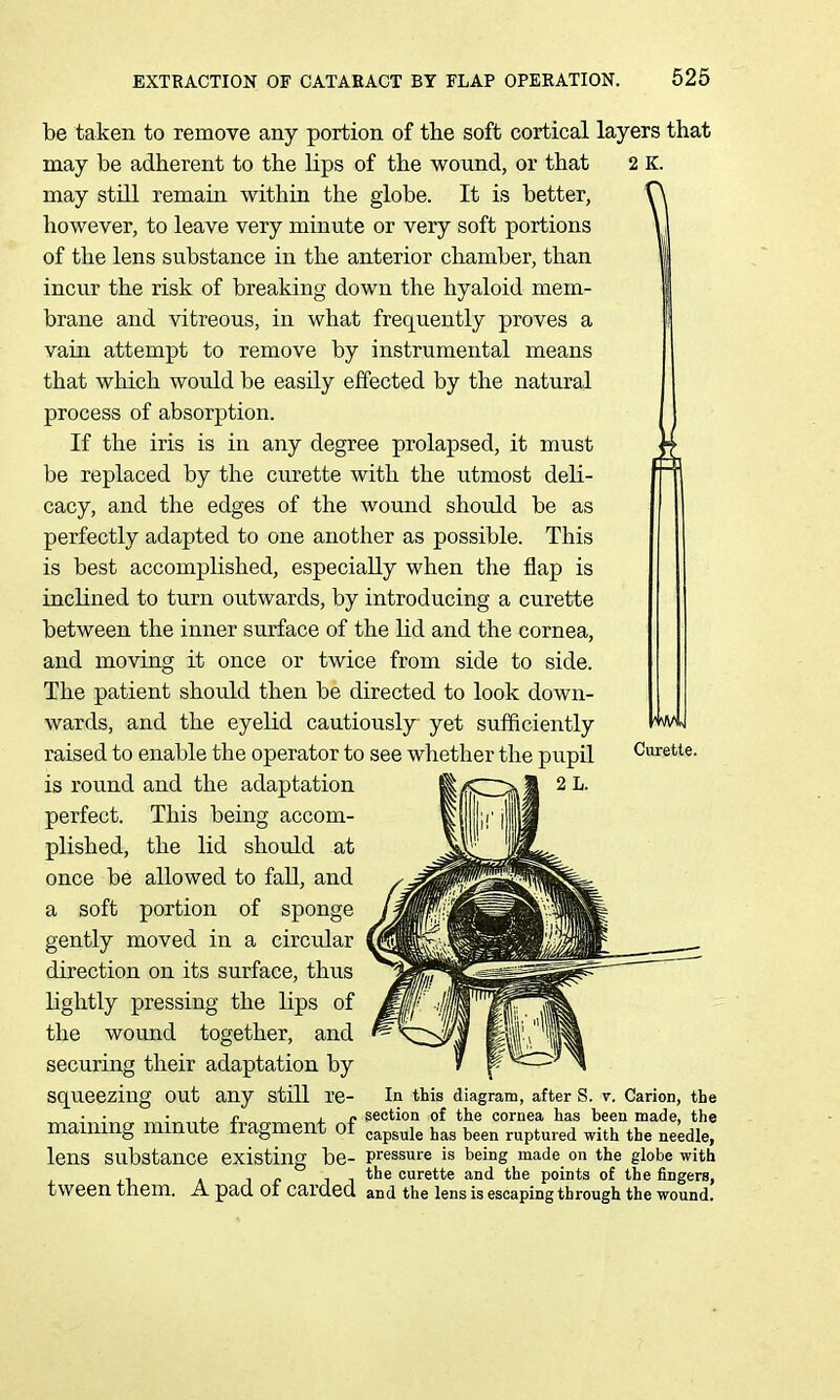 be taken to remove any portion of the soft cortical layers that may be adherent to the lips of the wound, or that 2 K. may still remain within the globe. It is better, however, to leave very minute or very soft portions of the lens substance in the anterior chamber, than incur the risk of breaking down the hyaloid mem- brane and vitreous, in what frequently proves a vain attempt to remove by instrumental means that which would be easily effected by the natural process of absorption. If the iris is in any degree prolapsed, it must be replaced by the curette with the utmost deli- cacy, and the edges of the wound should be as perfectly adapted to one another as possible. This is best accomplished, especially when the flap is inclined to turn outwards, by introducing a curette between the inner surface of the lid and the cornea, and moving it once or twice from side to side. The patient should then be directed to look down- wards, and the eyelid cautiously yet sufficiently raised to enable the operator to see whether the pupil Curette, is round and the adaptation perfect. This being accom- plished, the lid shotild at once be allowed to fall, and a soft portion of sponge gently moved in a circidar direction on its surface, thus lightly pressing the lips of the wound together, and securing their adaptation by squeezing out any still re- In this diagram, after S. V. Carion, the ■ • • J. r J. jy section of the cornea has been made, the mammg mmute fragment of capsule has been ruptured with the needle, lens substance existing be- pressure is being made on the globe with -. A 1 r 1 1 curette and the points of the fingers, tween them. A pad Ot carded and the lens is escaping through the wound.