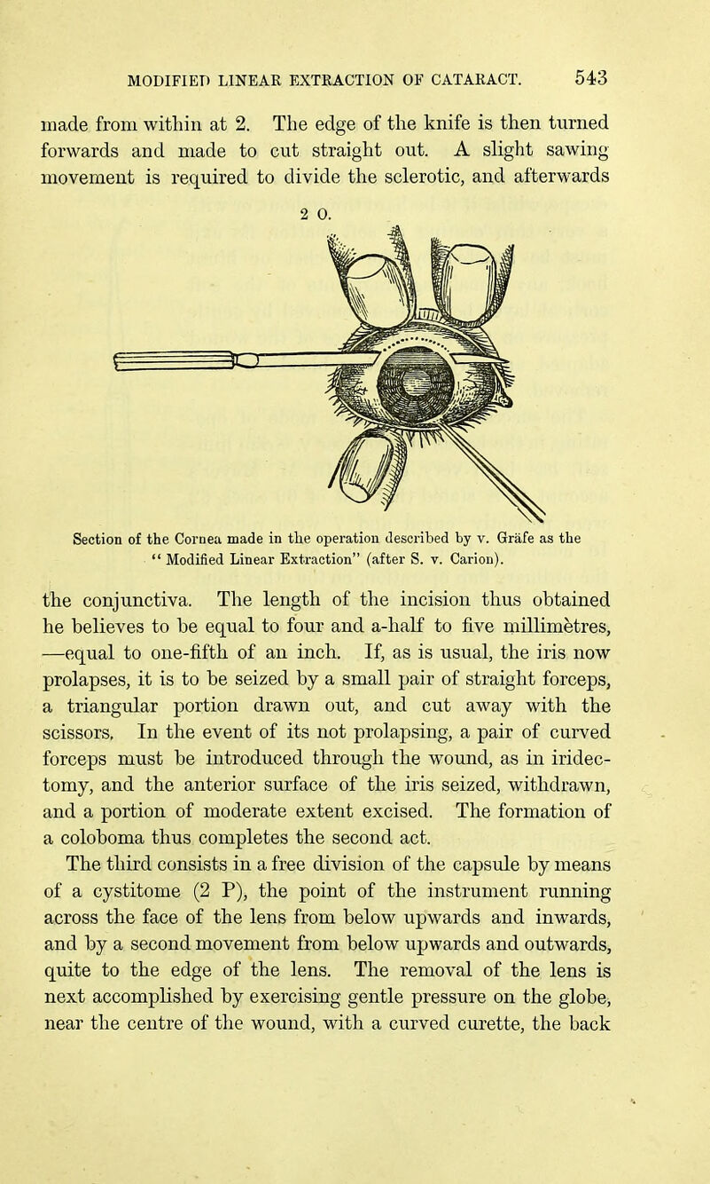 made from within at 2. The edge of the knife is then turned forwards and made to cut straight out. A slight sawing movement is required to divide the sclerotic, and afterwards 2 0. Section of the Cornea made in tlie operation described by v. Grafe as the  Modified Linear Extraction (after S. v. Carion). the conjunctiva. The length of the incision thus obtained he believes to be equal to four and a-half to five millimetres, —equal to one-fifth of an inch. If, as is usual, the iris now prolapses, it is to be seized by a small pair of straight forceps, a triangular portion drawn out, and cut away with the scissors, In the event of its not prolapsing, a pair of curved forceps must be introduced through the wound, as in iridec- tomy, and the anterior surface of the iris seized, withdrawn, and a portion of moderate extent excised. The formation of a coloboma thus completes the second act. The third consists in a free division of the capsule by means of a cystitome (2 P), the point of the instrument running across the face of the lens from below upwards and inwards, and by a second movement from below upwards and outwards, quite to the edge of the lens. The removal of the lens is next accomplished by exercising gentle pressure on the globe, near the centre of tlie wound, with a curved curette, the back