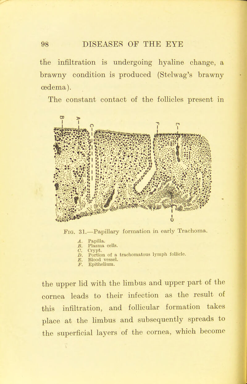 tEe infiltration is undergoing hyaline change, a brawny condition is produced (Stelwag's brawny oedema). The constant contact of the follicles present in Fig. 31.—Papillary formation in early Trachoma. A. Papilla. B. Plasma cells. C. Crypt. D. Portion of a trachomatous lyiupli follicle. B. Blood vessel. F. Epithelium. the upper hd with the hmbus and upper part of the cornea leads to their infection as the result of this infiltration, and follicular formation takes place at the hmbus and subsequently spreads to the superficial layers of the cornea, which become