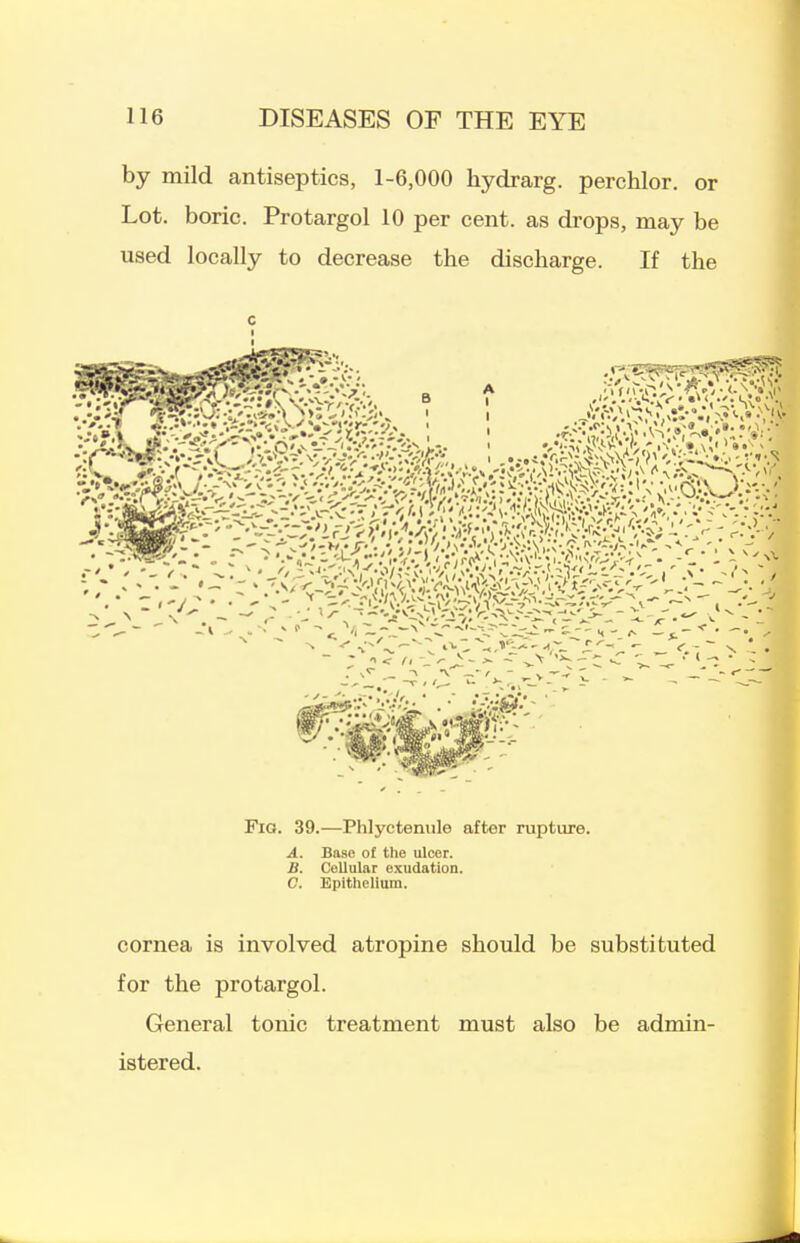 by mild antiseptics, 1-6,000 hydrarg. perchlor. or Lot. boric. Protargol 10 per cent, as drops, may be used locally to decrease the discharge. If the c Fia. 39.—Phlyctenule after rupture. A. Base of the ulcer. B. Cellular exudation. C. Epithelium. cornea is involved atropine should be substituted for the protargol. General tonic treatment must also be admin- istered.