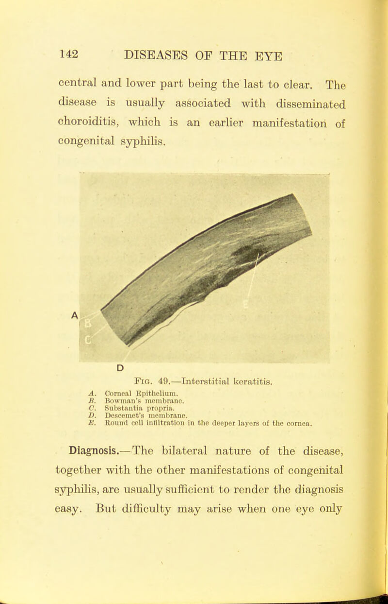 central and lower part being the last to clear. The disease is usually associated with disseminated choroiditis, which is an earlier manifestation of congenital syphihs. A D Fig. 49.—Interstitial keratitis. A. Corneal Eiiitlicliuin. B. Bowman's membrane. C. Substantia propria. D. Descemet's niembrano. E. Round cell infiltration in the deeper layers of tlie cornea. Diagnosis.— The bilateral nature of the disease, together with the other manifestations of congenital syphilis, are usually sufficient to render the diagnosis easy. But difficulty may arise when one eye only