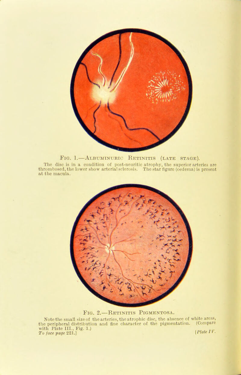 Fig. 1.—Albumtnurto Retinitis (late stage). The disc is in a condition of post-neiiritic atro[)liy, tlio superior arteries nre tlironil)09ed, tlie lower sliow arterial sclerosis. Tlie star llgiiro (oedema) is present at tlie macula.