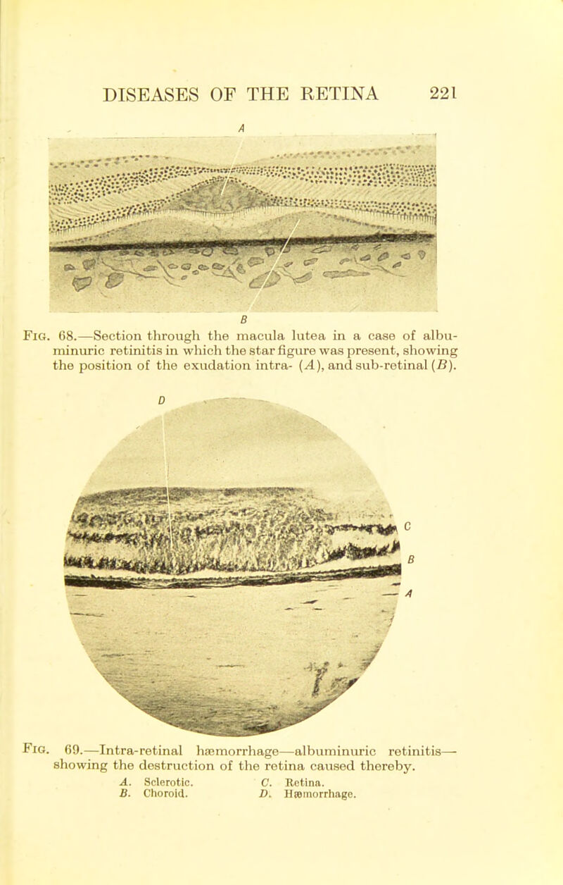 A B Fig. 68.—Section throvigh the macula lutea in a case of albu- minuric retinitis in which the star figure was present, showing the position of the exudation intra- {A), and sub-retinal {B). D Fig. 69.—Intra-retinal haemorrhage—albuminuric retinitis- showing the destruction of the retina caused thereby. A. Sclerotic. C. Retina. B. Choroid. D. Hsemorrhage.