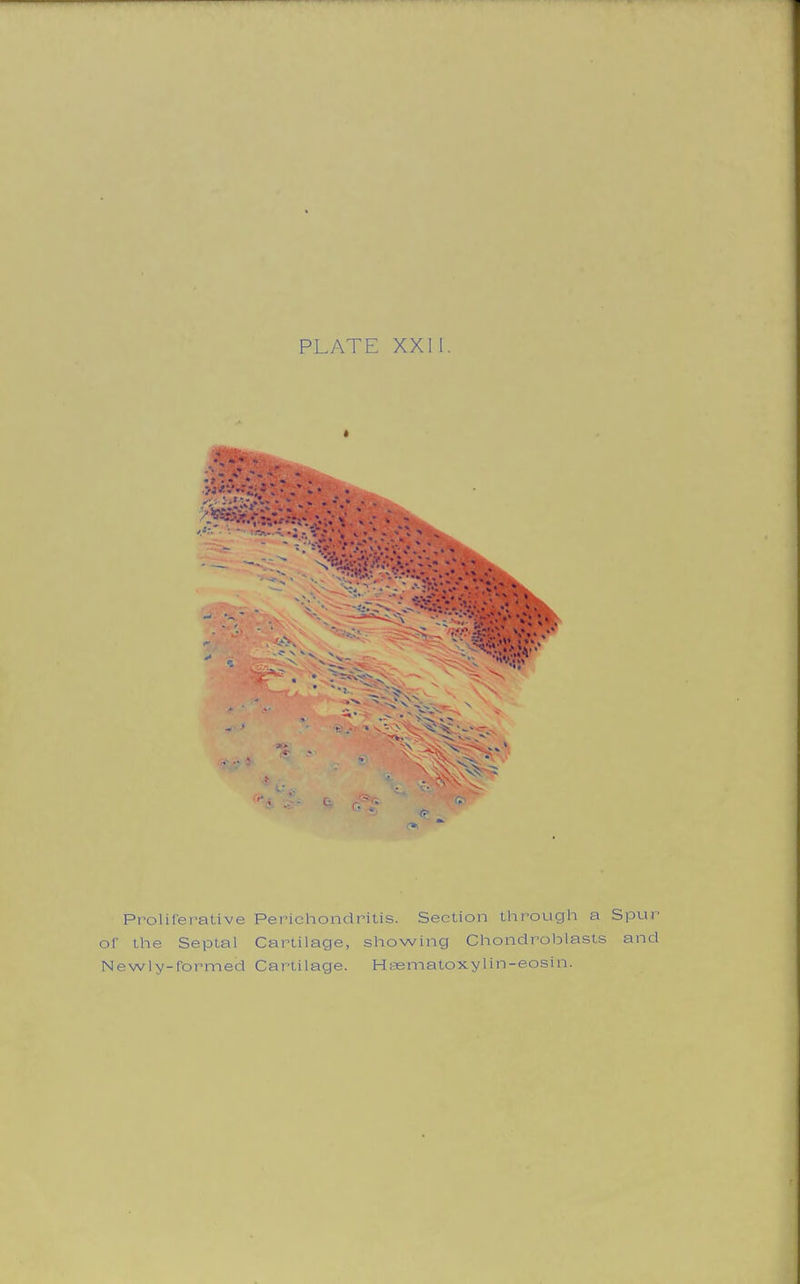 PLATE XXII. Proliferative Perichondritis. Section through a Spur or the Septal Cartilage, showing Chondroblasts and Newly-formed Cartilage. Hsematoxylin-eosin.