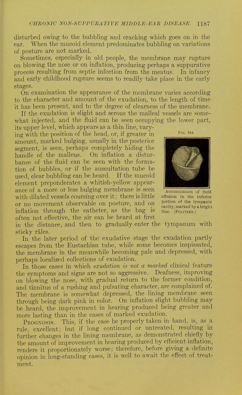 disturbed owing to the bubbling and cracking which goes on in the ear. When the mucoid element predominates bubbling on variations of posture are not marked. Sometimes, especially in old people, the membrane may rupture on blowing the nose or on inflation, producing perhaps a suppurative process resulting from septic infection from the meatus. In infancy and early childhood rupture seems to readily take place in the early stages. On examination the appearance of the membrane varies according to the character and amount of the exudation, to the length of time it has been present, and to the degree of clearness of the membrane. If the exudation is slight and serous the malleal vessels are some- what injected, and the fluid can be seen occupying the lower part, its upper level, which appears as a thin line, vary- ing with the position of the head, or, if greater in amount, marked bulging, usually in the posterior segment, is seen, perhaps completely hiding the handle of the malleus. On inflation a distur- bance of the fluid can be seen with the forma- tion of bubbles, or if the auscultation tube be used, clear bubbling can be heard. If the mucoid element preponderates a whitish-yellow appear- ance of a more or less bulging membrane is seen 'Accumulation of fluid with dilated vessels coursing over it; there is little effusion in the inferior or no movement observable on posture, and on p0'0 of tyTT. u . . . ,, 1.1 . 1.1 i • cavity, marked by a bright inflation through the catheter, as the bag is line. (Politzer.) often not effective, the air can be heard at first in the distance, and then to gradually enter the tympanum with sticky rales. In the later period of the exudative stage the exudation partly escapes from the Eustachian tube, while some becomes inspissated, the membrane in the meanwhile becoming pale and depressed, with perhaps localized collections of exudation. In those cases in which exudation is not a marked clinical feature the symptoms and signs are not so aggressive. Deafness, improving on blowing the nose, with gradual return to the former condition, and tinnitus of a rushing and pulsating character, are complained of. The membrane is somewhat depressed, the lining membrane seen through being dark pink in color. On inflation slight bubbling may be heard, the improvement in hearing produced being greater and more lasting than in the cases of marked exudation. Prognosis. This, if the case be properly taken in hand, is, as a rule, excellent; but if long continued or untreated, resulting in further changes in the lining membrane, as demonstrated chiefly by the amount of improvement in hearing produced by efficient inflation, renders it proportionately worse; therefore, before giving a definite opinion in long-standing cases, it is well to await the effect of treat- ment.