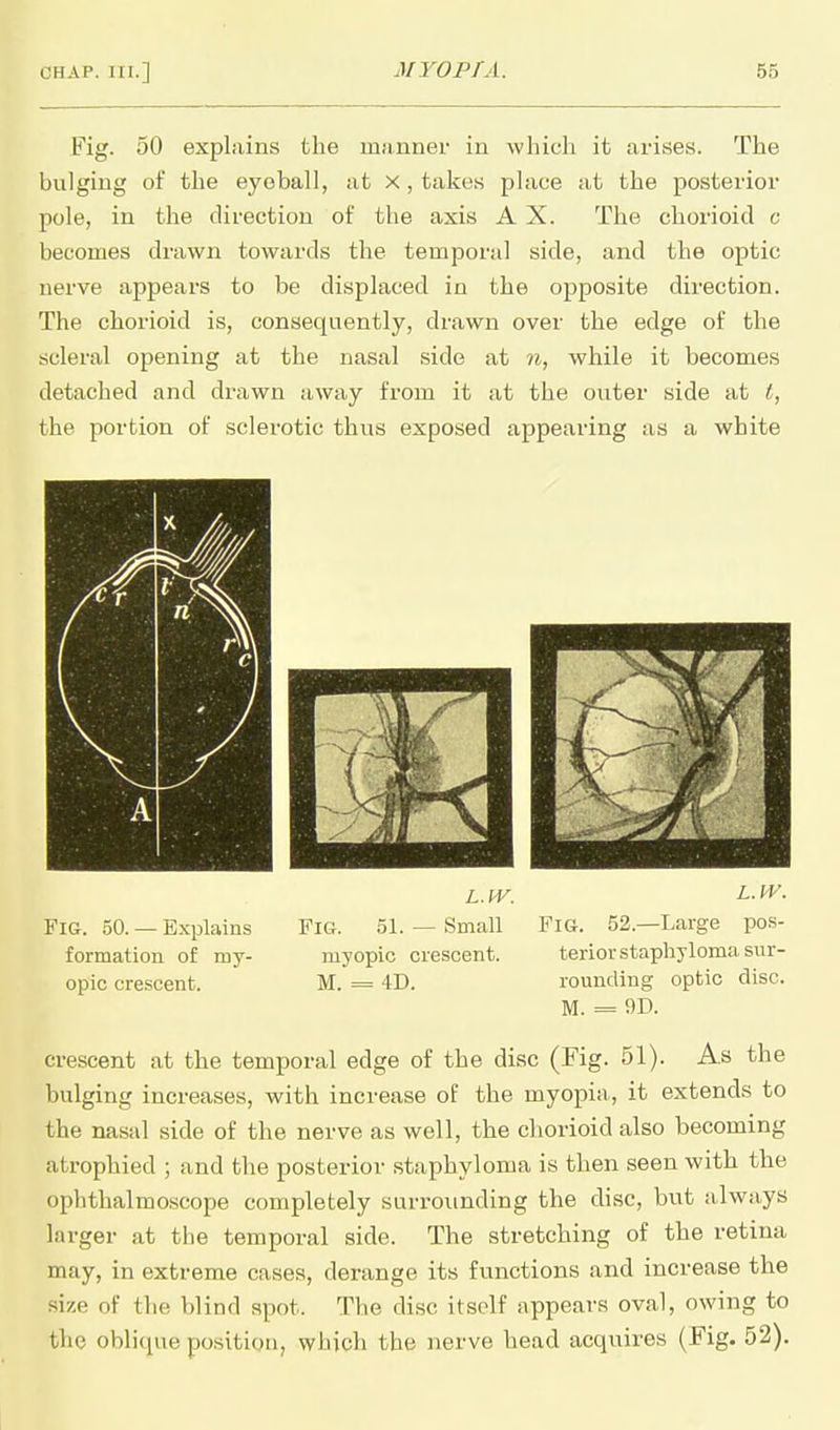 Fig. 50 explains the manner in which it arises. The bulging of the eyeball, at x, takes place at the posterior pole, in the direction of the axis A X. The chorioid c becomes drawn towards the temporal side, and the optic nerve appears to be displaced in the opposite direction. The chorioid is, consequently, drawn over the edge of the scleral opening at the nasal side at n, while it becomes detached and drawn away from it at the outer side at t, the portion of sclerotic thus exposed appearing as a white Fig. 50. — Explams formation of my- opic crescent. L.tV. Fig. 51. — Small myopic crescent. M. = 4D. L.IV. Fig. 52.—Large pos- terior staphyloma sur- rounding optic disc. M. = !)D. crescent at the temporal edge of the disc (Fig. 51). As the bulging increases, with increase of the myopia, it extends to the nasal side of the nerve as well, the chorioid also becoming atrophied ; and the posterior staphyloma is then seen with the ophthalmoscope completely surrounding the disc, but always larger at the temporal side. The stretching of the retina may, in extreme cases, derange its functions and increase the size of the blind spot. Tlie disc itself appears oval, owing to the oblique position, which the nerve head acquires (Fig. 52).