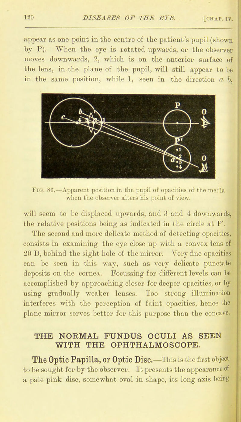 appear as one point in the centre of the patient's pupil (shown by P). When the eye is rotated upwards, or the observer moves downwards, 2, which is on the anterior surface of the lens, in the plane of the pupil, will still appear to be in the same position, while 1, seen in the direction a b, Fig. 86.—Apparent position in the pupil of opacities of tlie media when the observer alters his j)oint of view. will seem to be displaced upwards, and 3 and 4 downwards, the relative positions being as indicated in the circle at P'. The second and more delicate method of detecting opacities, consists in examining the eye close up with a convex lens of 20 D, behind the sight hole of the mirror. Very fine opacities can be seen in this way, such as very delicate punctate deposits on the cornea. Focussing for different levels can be accomplished by approaching closer for deeper opacities, or by using gradually weaker lenses. Too strong illumination interferes with the perception of faint opacities, hence the plane mirror serves better for this purpose than the concave. THE NORMAL FUNDUS OCULI AS SEEN WITH THE OPHTHALMOSCOPE. The Optic Papilla, or Optic Disc—This is the first object to be sought for by the observer. It presents the appearance of a pale pink disc, somewhat oval in shape, its long axis being