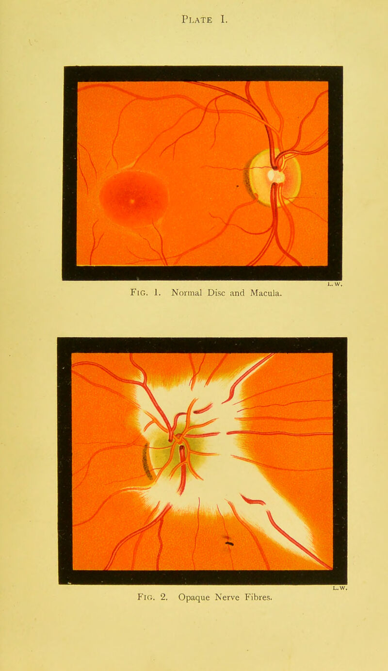 L. W. Fig. 1. Normal Disc and Macula. L.W.