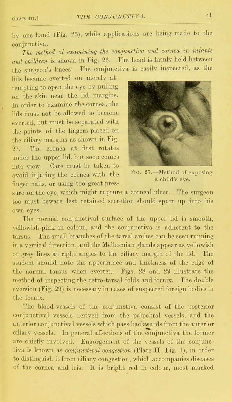 11 Fig. 27.—Method of exposing a child's eye. by one hand (Fig. 25), while applications are being made to the conjunctiva. The method of examining the conjunctiva and cornea in infants and children is shown in Fig. 26. The head is firmly held between the surgeon's knees. The conjunctiva is easily inspected, as the lids become everted on merely at- tempting to open the eye by pulling on the skin near the lid margins. In order to examine the cornea, the lids must not be allowed to become everted, but must be separated with the points of the fingers placed on the ciliary margins as shown in Fig. 27. The cornea at first rotates under the upper lid, but soon comes into view. Care must be taken to avoid injuring the cornea with the finger nails, or using too great pres- sure on the eye, which might rupture a corneal ulcer. The surgeon too must beware lest retained secretion should spurt up into his own eyes. The normal conjunctival surface of the upper lid is smooth, yellowish-pink in colour, and the conjunctiva is adherent to the tarsus. The small branches of the tarsal arches can be seen running in a vertical direction, and the Meibomian glands appear as yellowish or grey lines at right angles to the ciliary margin of the lid. The student should note the appearance and thickness of the edge of the normal tarsus when everted. Figs. 28 and 29 illustrate the method of inspecting the retro-tarsal folds and fornix. The double cversion (Fig. 29) is necessary in cases of suspected foreign bodies in the fornix. The blood-vessels of the conjunctiva consist of the posterior conjunctival vessels derived from the palpebral vessels, and the anterior conjunctival vessels which pass backwards from the anterior ciliary vessels. In general affections of the conjunctiva the former are chiefly involved. Engorgement of the vessels of the conjunc- tiva is known as conjunctival congestion (Plate II. Fig. 1), in order to distinguish it from ciliary congestion, which accompanies diseases of the cornea and iris. It is bright red in colour, most marked