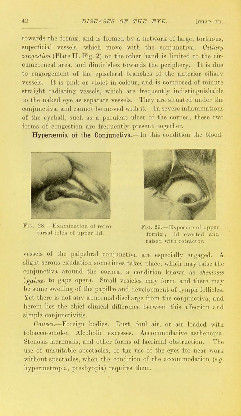 towards the fornix, and is formed by a network of large, tortuous, superficial vessels, which move with the conjunctiva. Ciliary congestion (Plate II. Fig. 2) on the other hand is limited to the cir- cumcorneal area, and diminishes towards the periphery. It is due to engorgement of the episcleral branches of the anterior ciliary vessels. It is pink or violet in colour, and is composed of minute straight radiating vessels, which are frequently indistinguishable to the naked eye as separate vessels. They are situated under the conjunctiva, and cannot be moved with it. In severe inflammations of the eyeball, such as a purulent ulcer of the cornea, these two forms of congestion are frequently present together. Hyperemia of the Conjunctiva.—In this condition the blood- barsal folds of upper lid. fornix ; lid everted and raised with retractor. vessels of the palpebral conjunctiva arc especially engaged. A slight serous exudation sometimes takes place, which may raise the conjunctiva around the cornea, a condition known as chemosis (^atVw, to gape open). Small vesicles may form, and there may be some swelling of the papillae and development of lymph follicles. Yet there is not any abnormal discharge from the conjunctiva, and herein lies the chief clinical difference between this affection and simple conjunctivitis. Causes.—Foreign bodies. Dust, foul air, or air loaded with tobacco-smoke. Alcoholic excesses. Accommodative asthenopia. Stenosis lacrimalis, and other forms of lacrimal obstruction. The use of unsuitable spectacles, or the use of the eyes for near work without spectacles, when the condition of the accommodation (e.g. hypermetropia, presbyopia) requires them.
