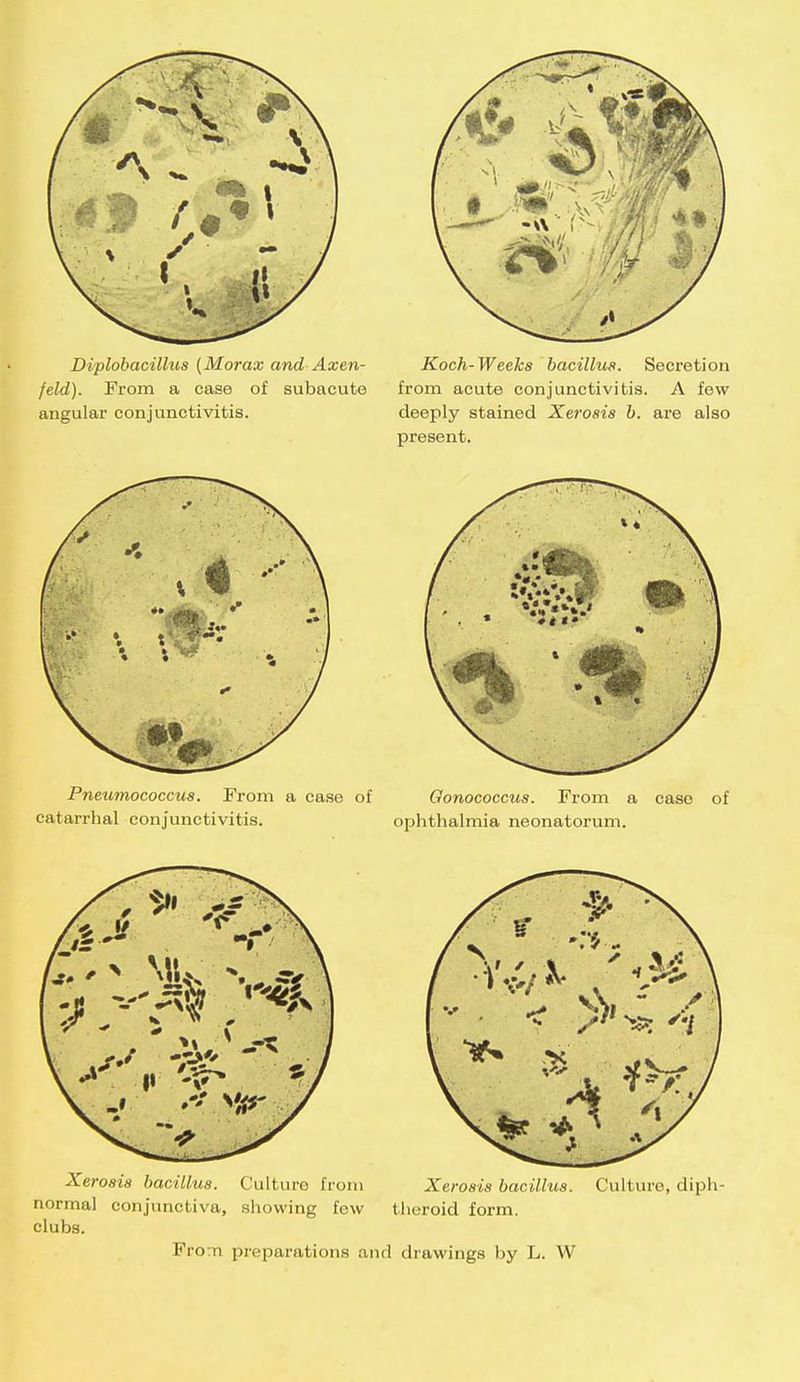 Diplobacillus (Morax and Axen- Koch-Weeks bacillus. Secretion feld). From a case of subacute from acute conjunctivitis. A few angular conjunctivitis. deeply stained Xerosis b. are also present. Xerosis bacillus. Culturo from Xerosis bacillus. Culture, diph- normal conjunctiva, showing few theroid form, clubs. From preparations and drawings by L. W