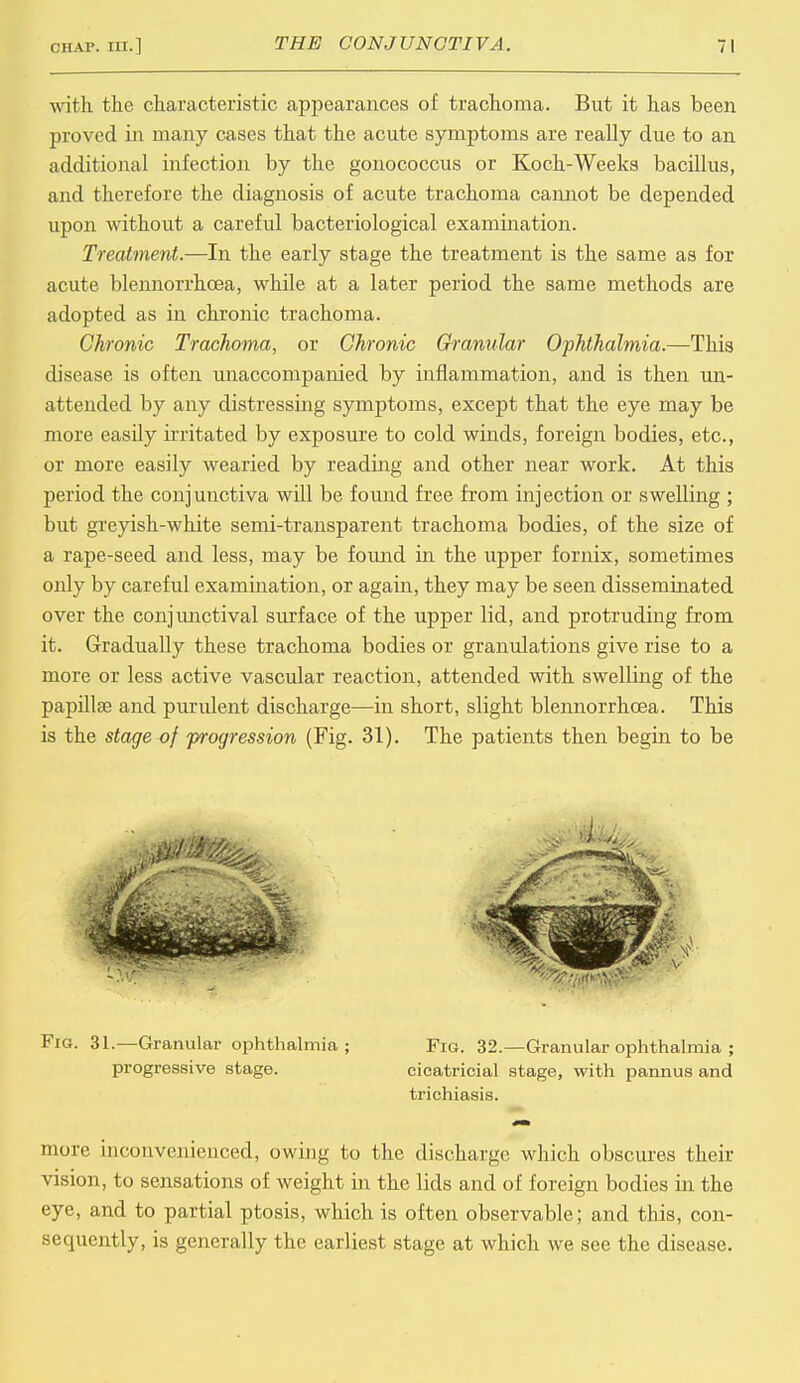 with the characteristic appearances of trachoma. But it has been proved in many cases that the acute symptoms are really due to an additional infection by the gonococcus or Koch-Weeks bacillus, and therefore the diagnosis of acute trachoma cannot be depended upon without a careful bacteriological examination. Treatment.—In the early stage the treatment is the same as for acute blennorrhcea, while at a later period the same methods are adopted as in chronic trachoma. Chronic Trachoma, or Chronic Granular Ophthalmia.—This disease is often unaccompanied by inflammation, and is then un- attended by any distressing symptoms, except that the eye may be more easily irritated by exposure to cold winds, foreign bodies, etc., or more easily wearied by reading and other near work. At this period the conjunctiva will be found free from injection or swelling ; but greyish-white semi-transparent trachoma bodies, of the size of a rape-seed and less, may be found in the upper fornix, sometimes only by careful examination, or again, they may be seen disseminated over the conjunctival surface of the upper lid, and protruding from it. Gradually these trachoma bodies or granulations give rise to a more or less active vascular reaction, attended with swelling of the papillae and purulent discharge—in short, slight blennorrhcea. This is the stage of progression (Fig. 31). The patients then begin to be Fig. 31.—Granular ophthalmia ; Fig. 32.—Granular ophthalmia ; progressive stage. cicatricial stage, with pannus and trichiasis. more inconvenienced, owing to the discharge which obscures their vision, to sensations of weight in the lids and of foreign bodies in the eye, and to partial ptosis, which is often observable; and this, con- sequently, is generally the earliest stage at which we see the disease.