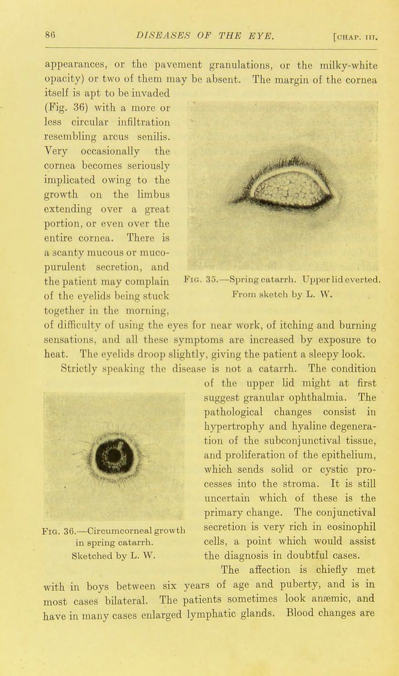 Fig. 35. Spring catarrh. Upper lid everted. Krom sketch by L. W. appearances, or the pavement granulations, or the milky-white opacity) or two of them may be absent. The margin of the cornea itself is apt to be invaded (Fig. 36) with a more or less circular infiltration resembling arcus senilis. Very occasionally the cornea becomes seriously implicated owing to the growth on the limbus extending over a great portion, or even over the entire cornea. There is a scanty mucous or muco- purulent secretion, and the patient may complain of the eyelids being st in k together in the morning, of difficulty of using the eyes for near work, of itching and burning sensations, and all these symptoms are increased by exposure to heat. The eyelids droop slightly, giving the patient a sleepy look. Strictly speaking the disease is not a catarrh. The condition of the upper lid might at first suggest granular ophthalmia. The pathological changes consist in hypertrophy and hyaline degenera- tion of the subconjunctival tissue, and proliferation of the epithelium, which sends solid or cystic pro- cesses into the stroma. It is still uncertain which of these is the primary change. The conjunctival secretion is very rich in eosinophil cells, a point which would assist the diagnosis in doubtful cases. Fig. 36.—Circumcorneal growth in spring catarrh. Sketched by L. W. The affection is chiefly met with in boys between six years of age and puberty, and is in most cases bilateral. The patients sometimes look anremic, and have in many cases enlarged lymphatic glands. Blood changes are