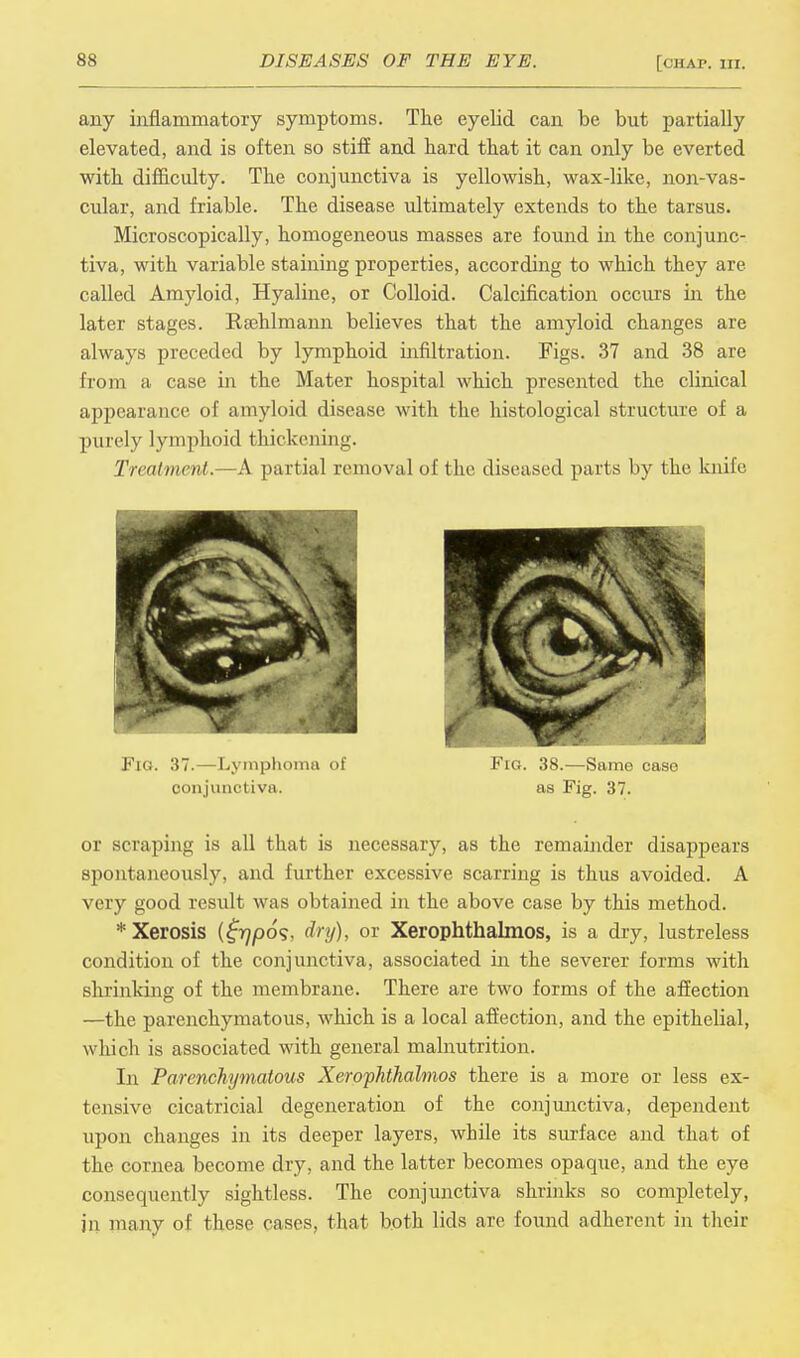 any inflammatory symptoms. The eyelid can be but partially elevated, and is often so stiff and hard that it can only be everted with difficulty. The conjunctiva is yellowish, wax-like, non-vas- cular, and friable. The disease ultimately extends to the tarsus. Microscopically, homogeneous masses are found in the conjunc- tiva, with variable staining properties, according to which they are called Amyloid, Hyaline, or Colloid. Calcification occurs in the later stages. Ksehlmann believes that the amyloid changes are always preceded by lymphoid infiltration. Figs. 37 and 38 are from a case in the Mater hospital which presented the clinical appearance of amyloid disease with the histological structure of a purely lymphoid thickening. Treatment.—A partial removal of the diseased parts by the knife or scraping is all that is necessary, as the remainder disappears spontaneously, and further excessive scarring is thus avoided. A very good result was obtained in the above case by this method. * Xerosis (£77/00?, iky), or Xerophthalmos, is a dry, lustreless condition of the conjunctiva, associated in the severer forms with shrinking of the membrane. There are two forms of the affection —the parenchymatous, which is a local affection, and the epithelial, which is associated with general malnutrition. In Parenchymatous Xerophthalmos there is a more or less ex- tensive cicatricial degeneration of the conjunctiva, dependent upon changes in its deeper layers, while its surface and that of the cornea become dry, and the latter becomes opaque, and the eye consequently sightless. The conjunctiva shrinks so completely, in many of these cases, that both lids are found adherent in their Fig. 37.—Lymphoma of conjunctiva. Fig. 38.—Same case as Fig. 37.