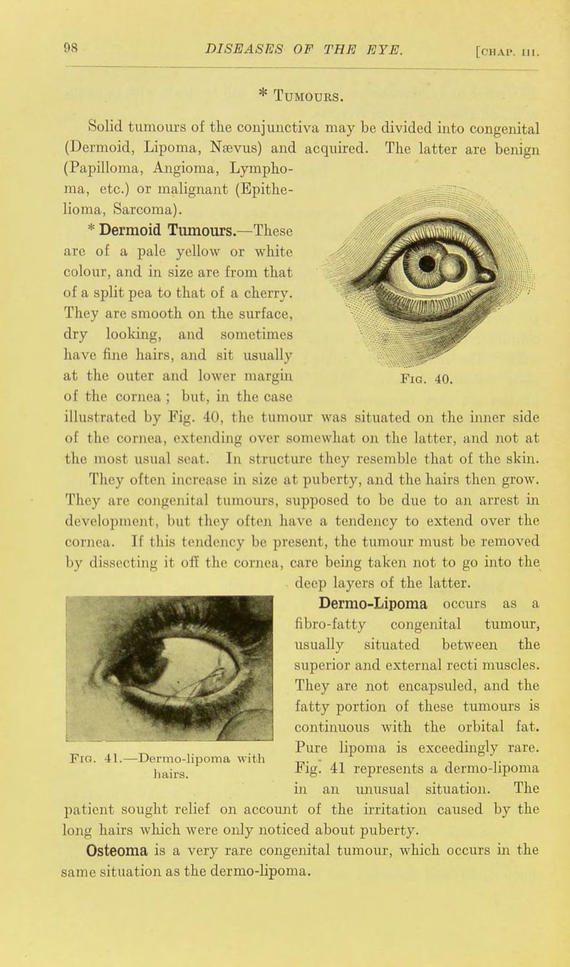 * Tumours. Fig. 40. Solid tumours of the conjunctiva may be divided into congenital (Dermoid, Lipoma, Nsevus) and acquired. The latter are benign (Papilloma, Angioma, Lympho- ma, etc.) or malignant (Epithe- lioma, Sarcoma). * Dermoid Tumours.—These arc of a pale yellow or white colour, and in size are from that of a split pea to that of a cherry. They are smooth on the surface, dry looking, and sometimes have fine hairs, and sit usually at the outer and lower margin of the cornea ; but, in the case illustrated by Fig. 40, the tumour was situated on the inner side of the cornea, extending over somewhat on the latter, and not at the most usual scat. In structure they resemble that of the skin. They often increase in size at puberty, and the hairs then grow. They are congenital tumours, supposed to be due to an arrest in development, but they often have a tendency to extend over the cornea. If this tendency be present, the tumour must be removed by dissecting it oft the cornea, care being taken not to go into the deep layers of the latter. Dermo-Lipoma occurs as a fibro-fatty congenital tumour, usually situated between the superior and external recti muscles. They are not encapsuled, and the fatty portion of these tumours is continuous with the orbital fat. Pure lipoma is exceedingly rare. Fig. 41 represents a dermo-lipoma in an unusual situation. The patient sought relief on account of the irritation caused by the long hairs which were only noticed about puberty. Osteoma is a very rare congenital tumour, which occurs in the same situation as the dermo-lipoma. Fro. 41.—Dermo-lipoma with hairs.